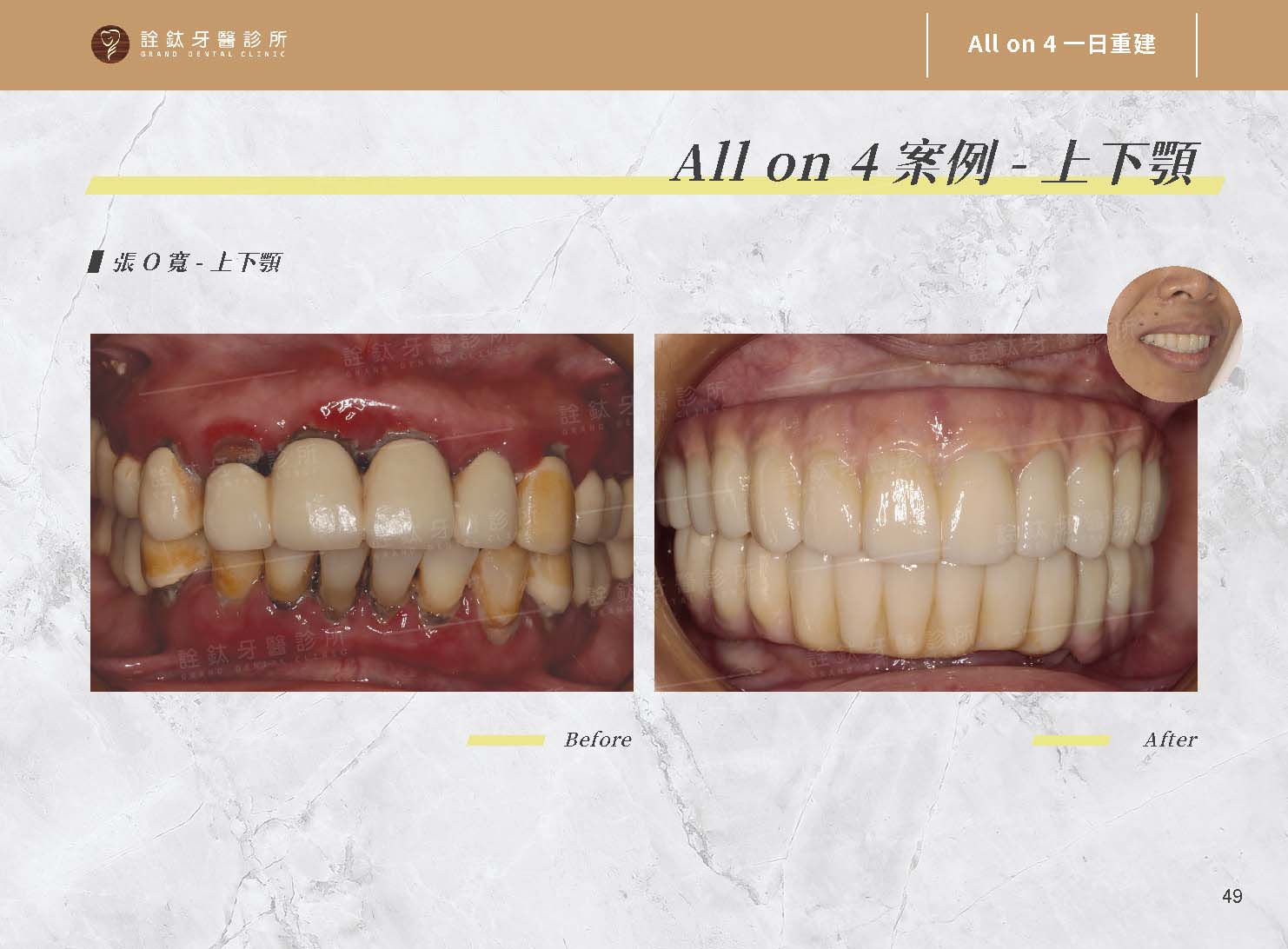 一日重建(All on 4/5/6) 一日重建(All on 4/5/6)