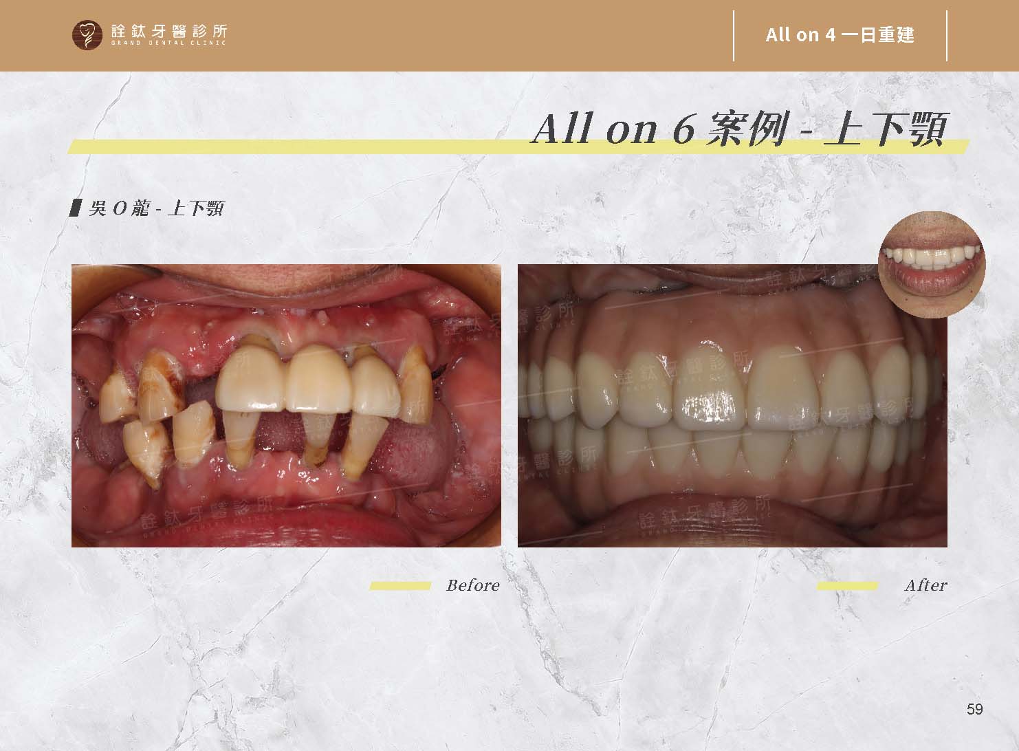 一日重建(All on 4/5/6) 一日重建(All on 4/5/6)