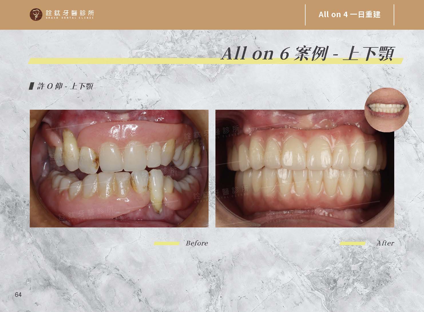 一日重建(All on 4/5/6) 一日重建(All on 4/5/6)