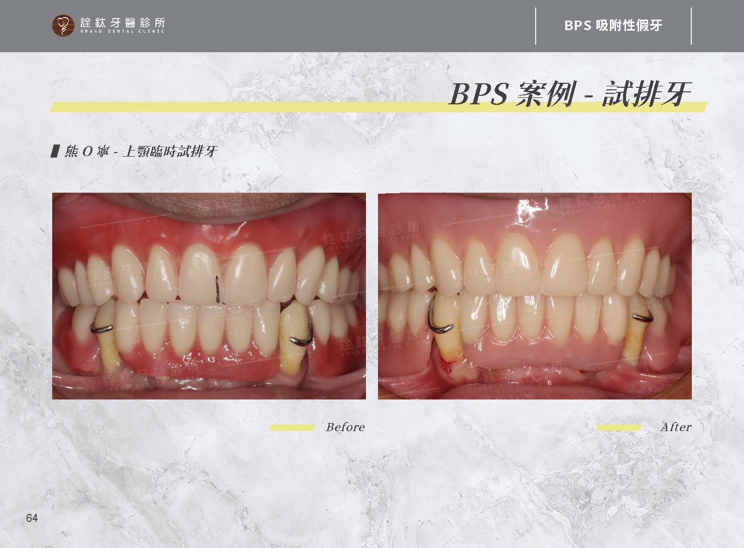 BPS吸附性假牙