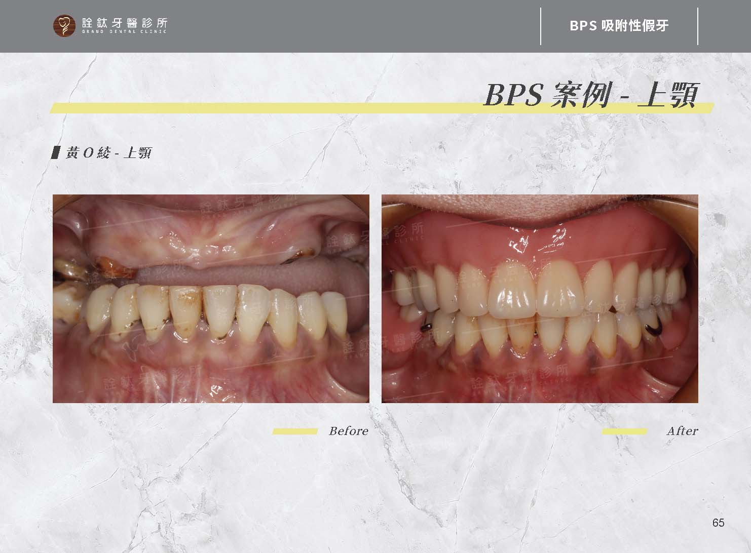 BPS吸附性假牙