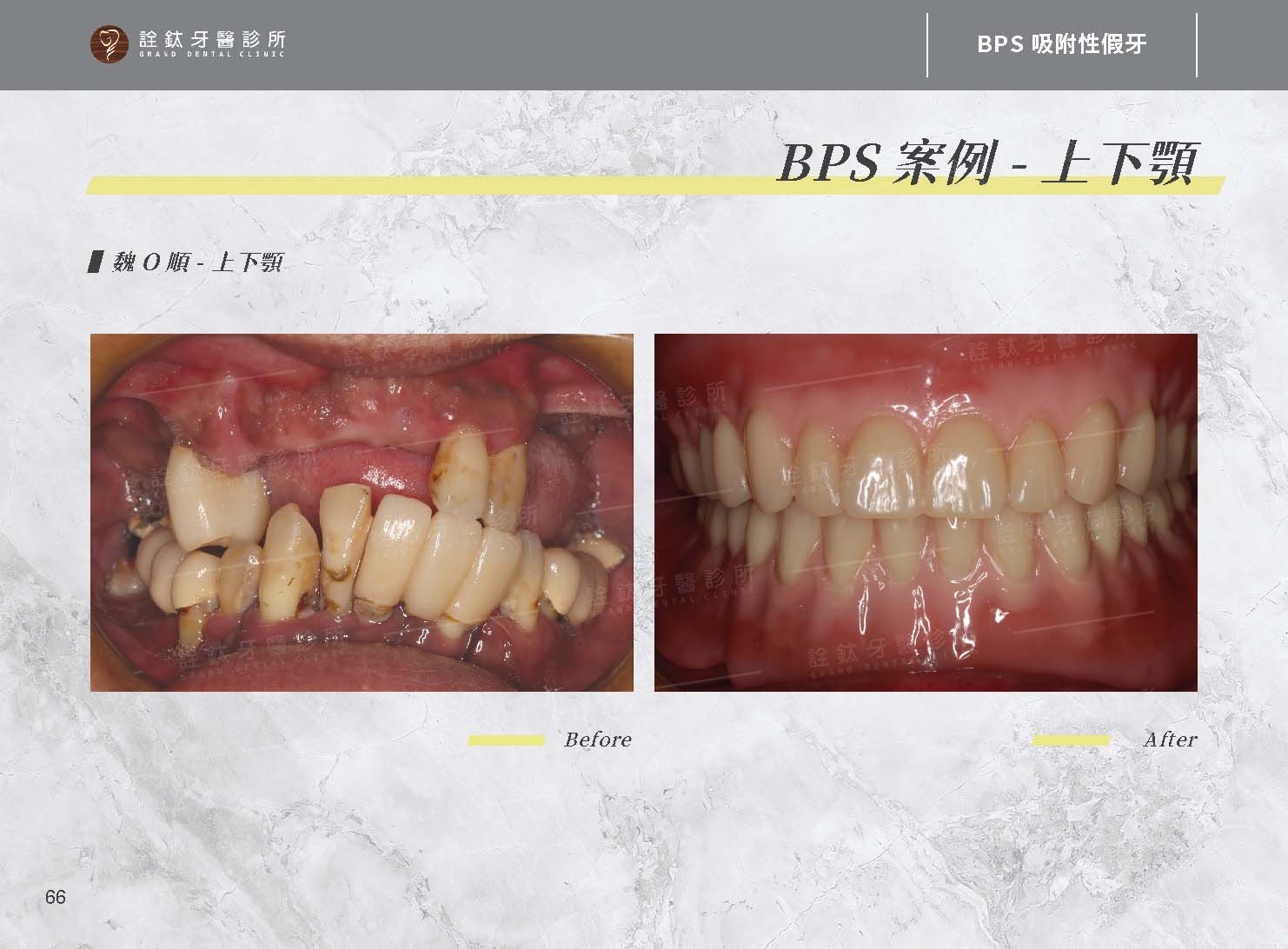 BPS吸附性假牙