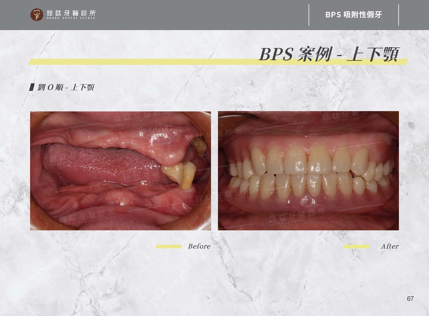BPS吸附性假牙
