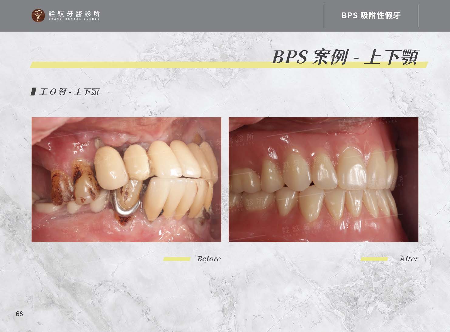 BPS吸附性假牙