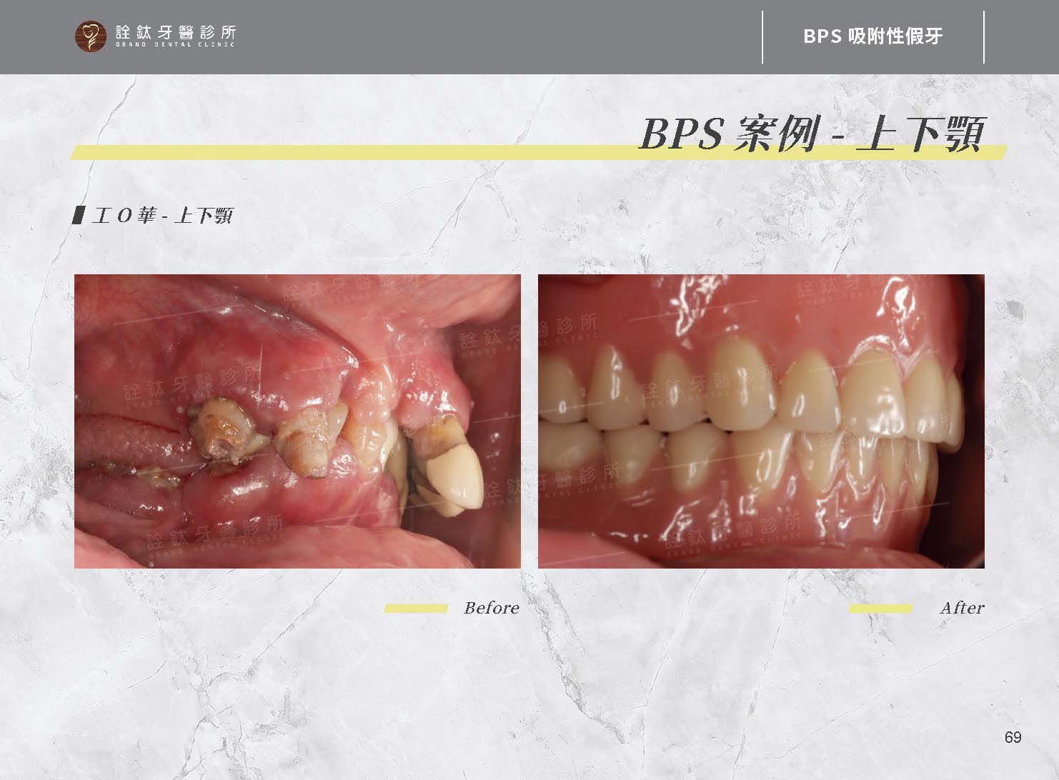 BPS吸附性假牙