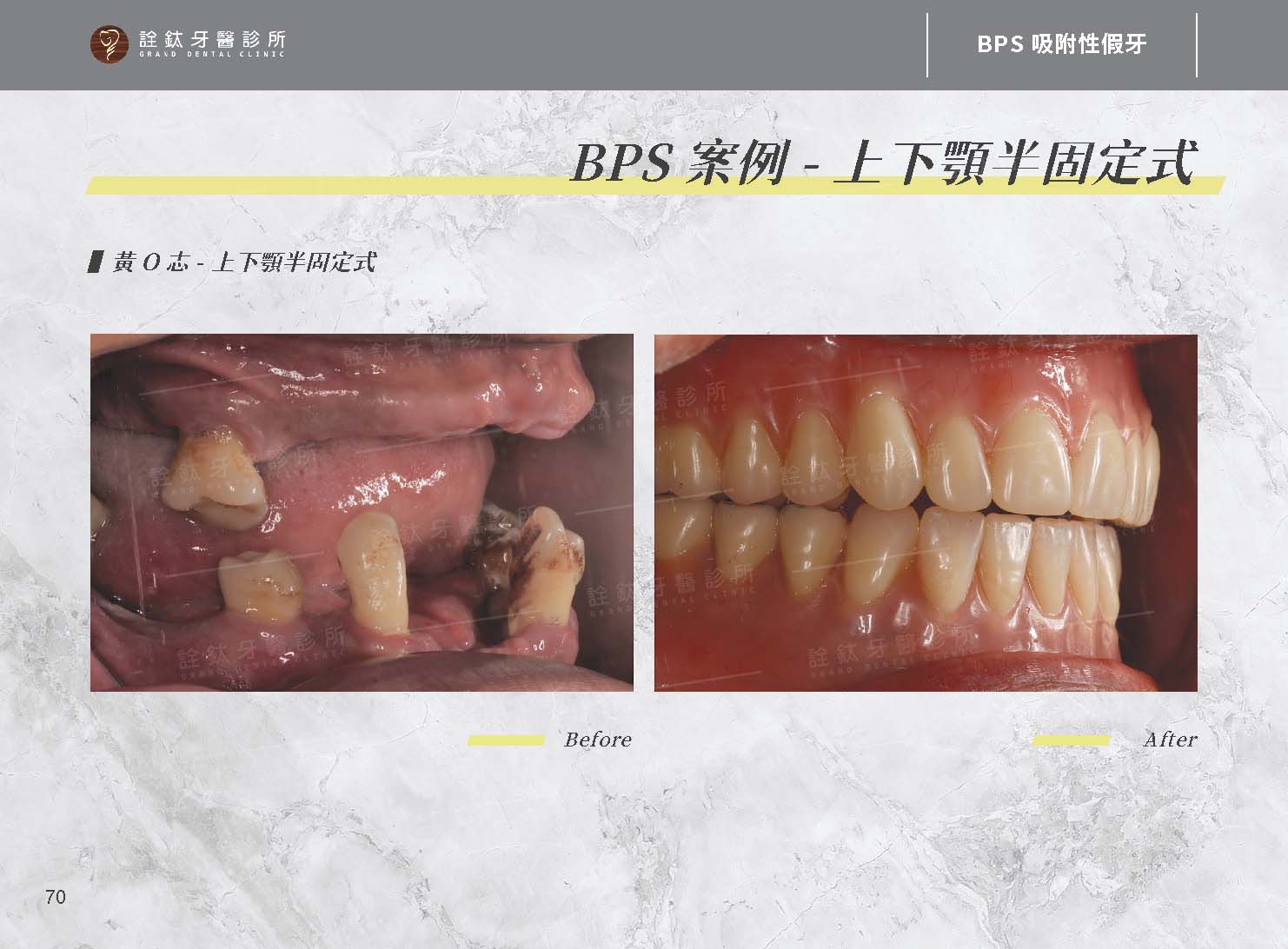 BPS吸附性假牙