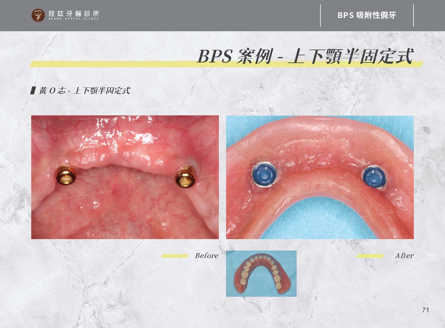 BPS吸附性假牙