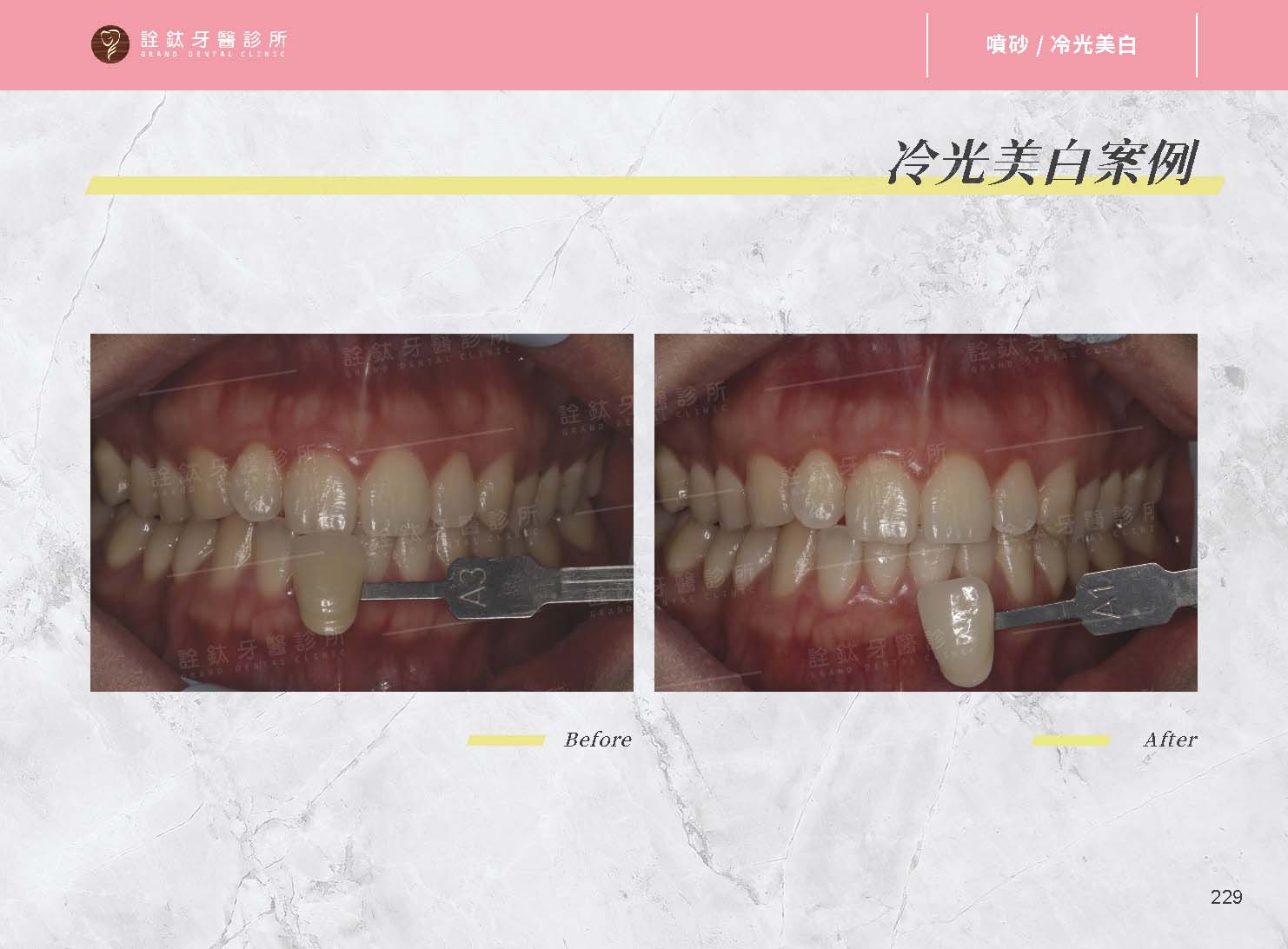 牙齒美白