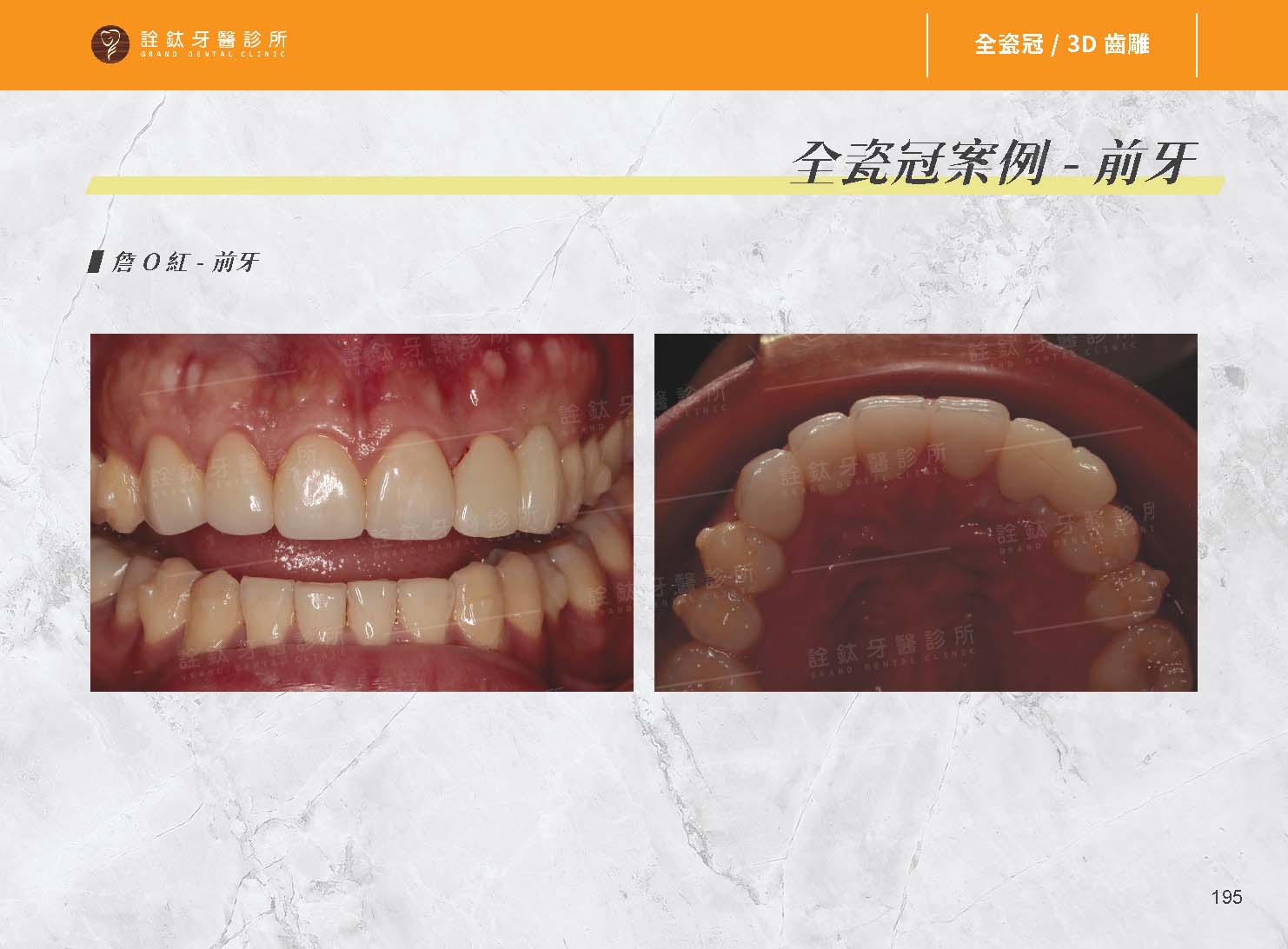 超仿真全瓷牙冠