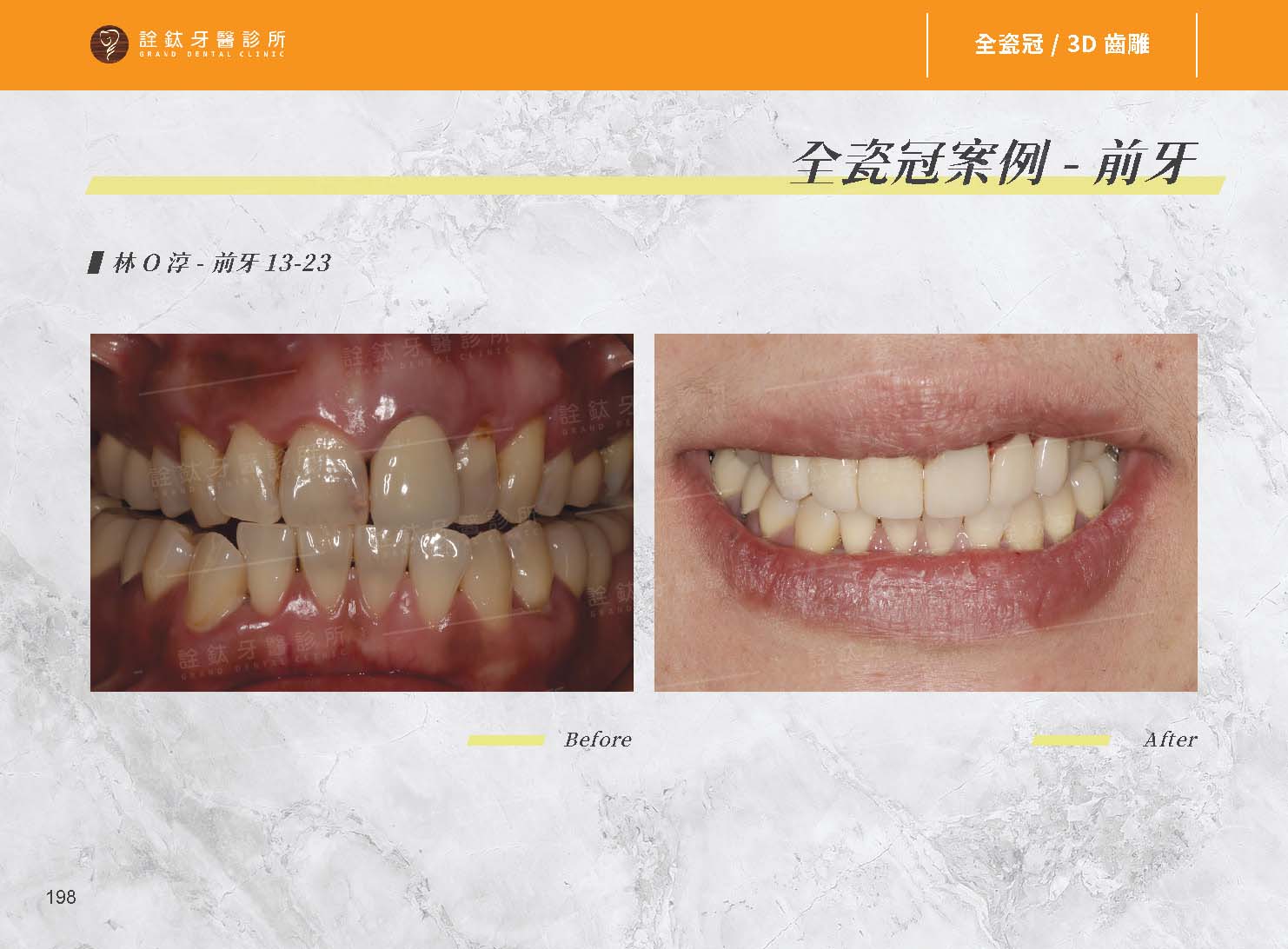 超仿真全瓷牙冠