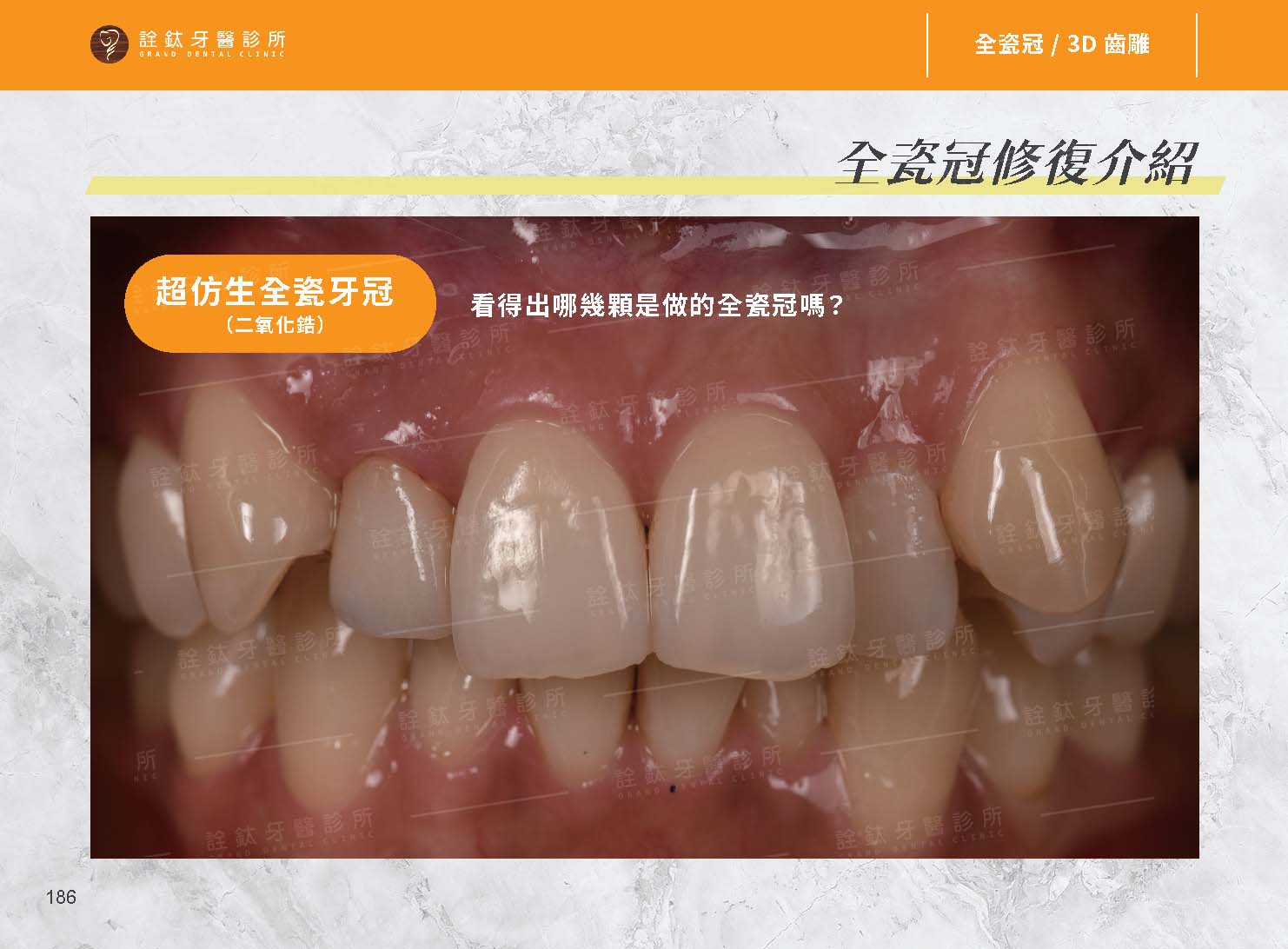超仿真全瓷牙冠