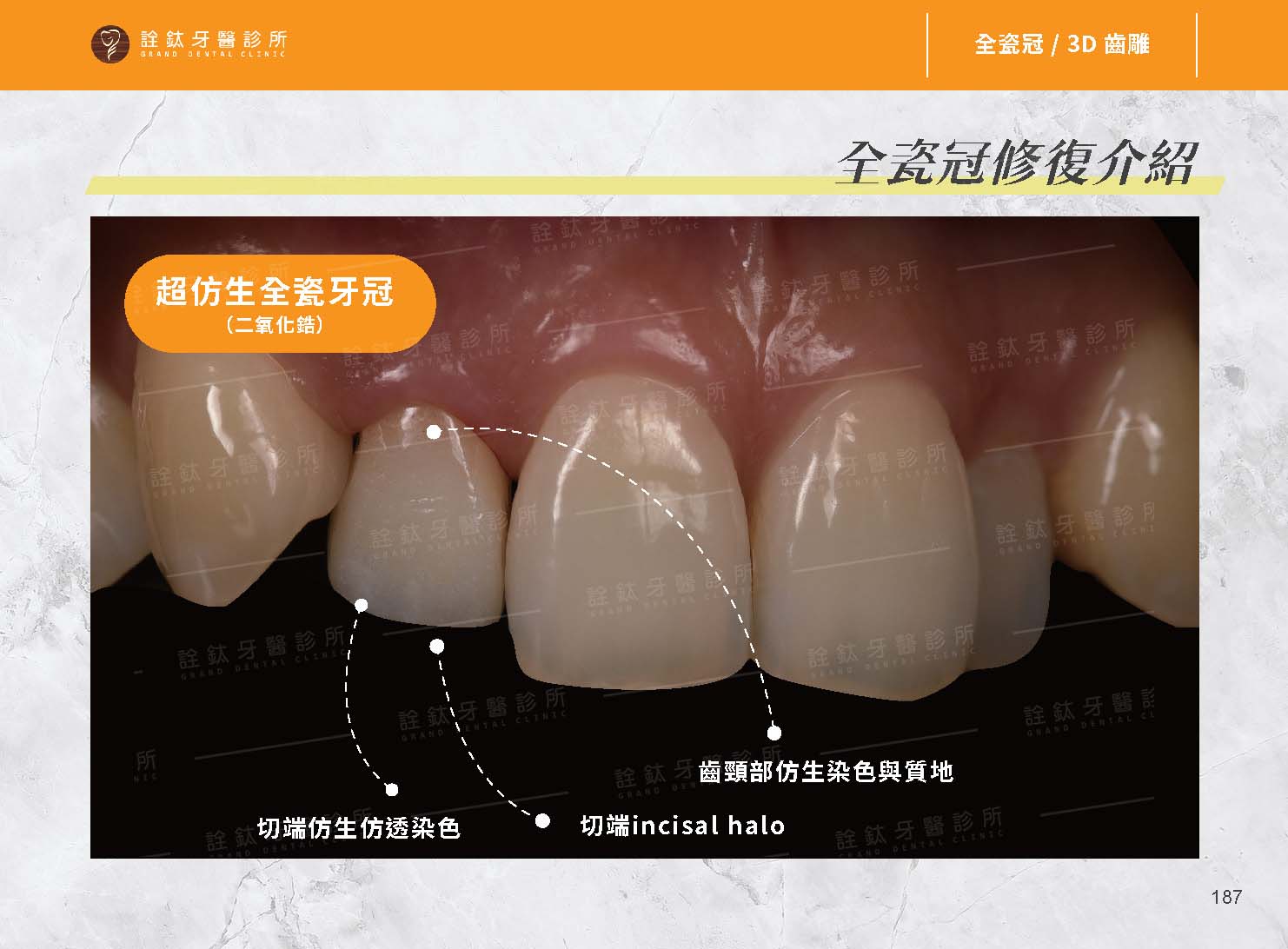 超仿真全瓷牙冠