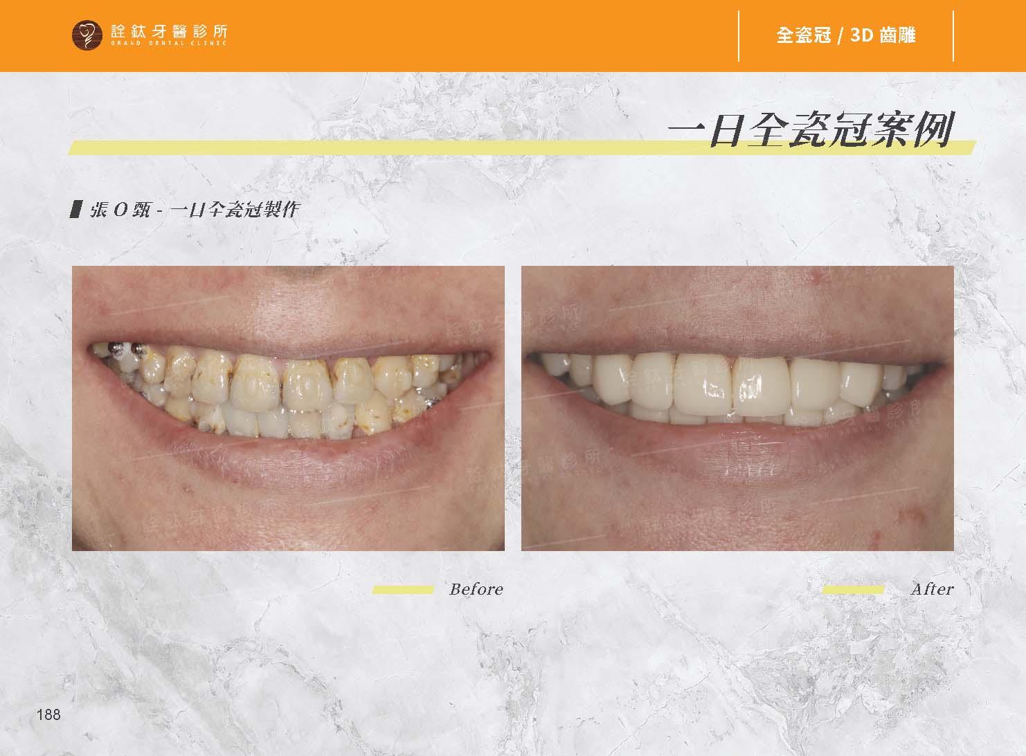 全瓷牙冠 全瓷牙冠