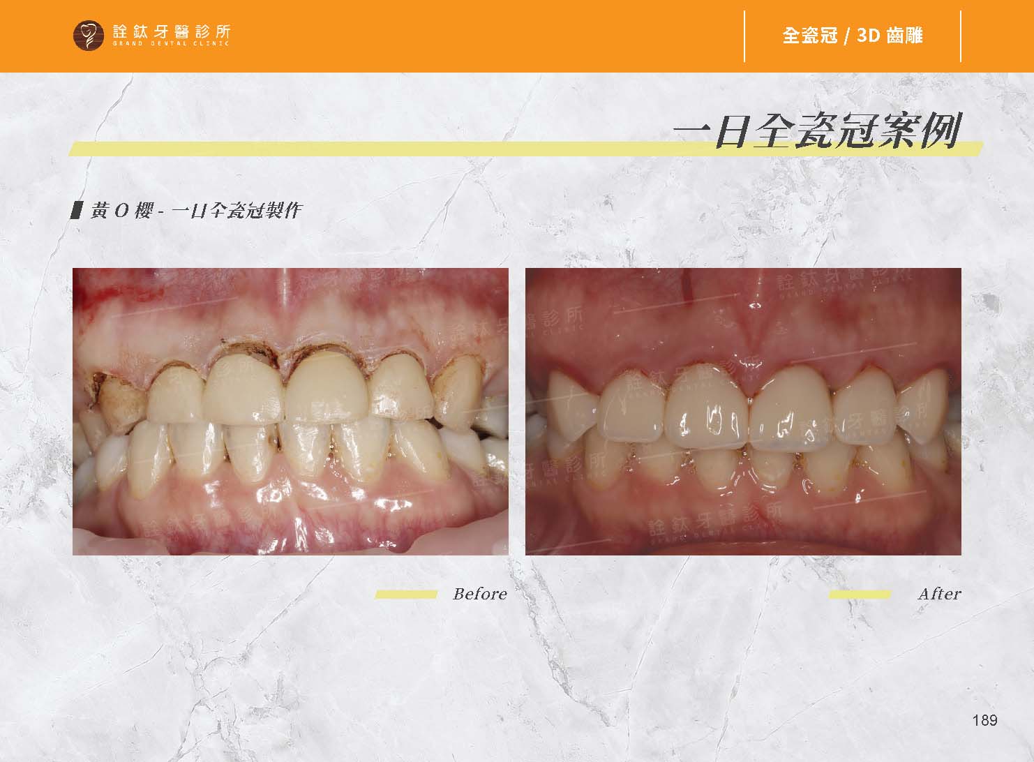 全瓷牙冠 全瓷牙冠