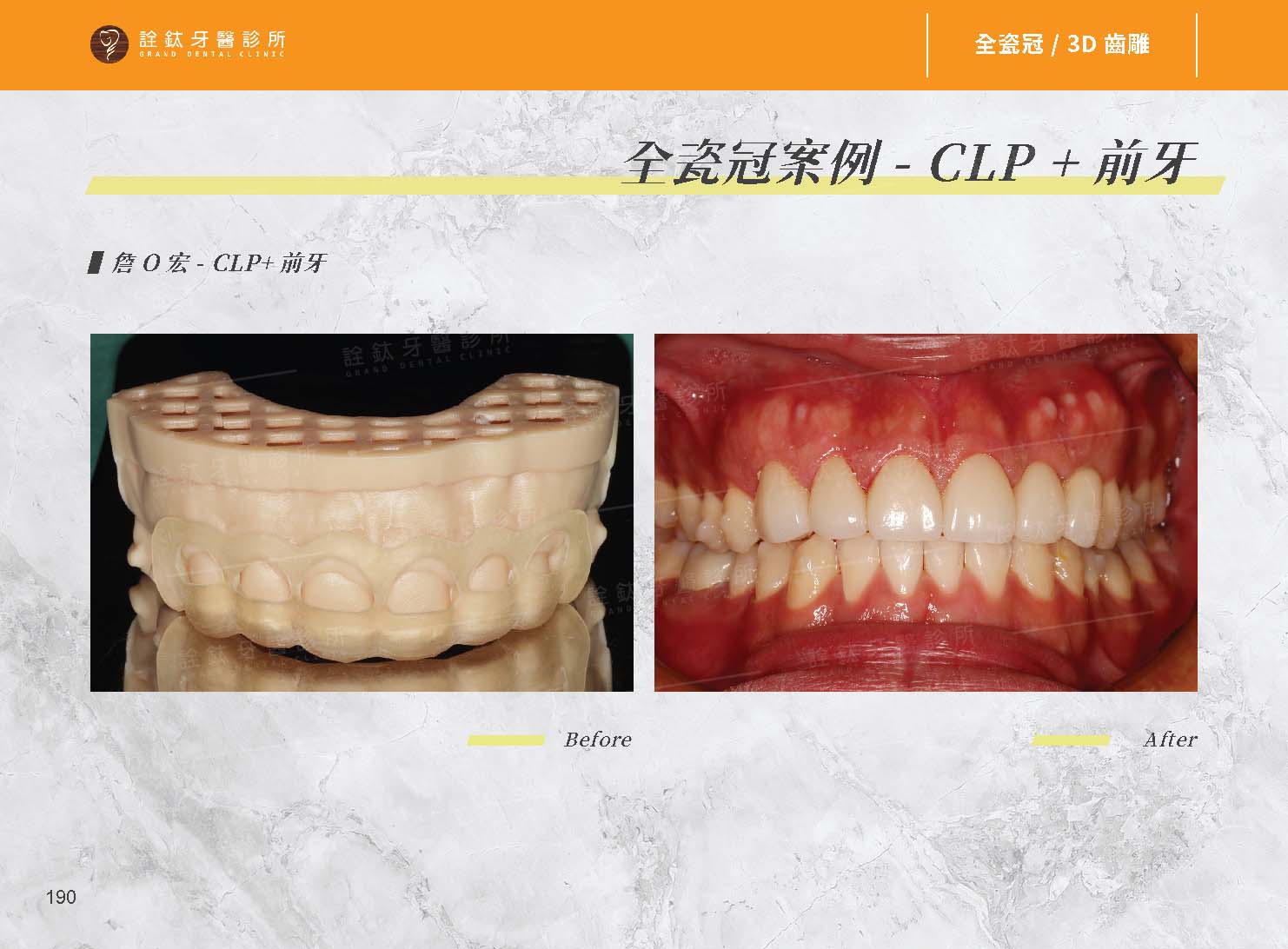 超仿真全瓷牙冠