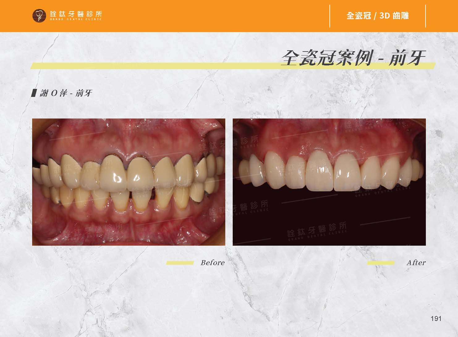 超仿真全瓷牙冠