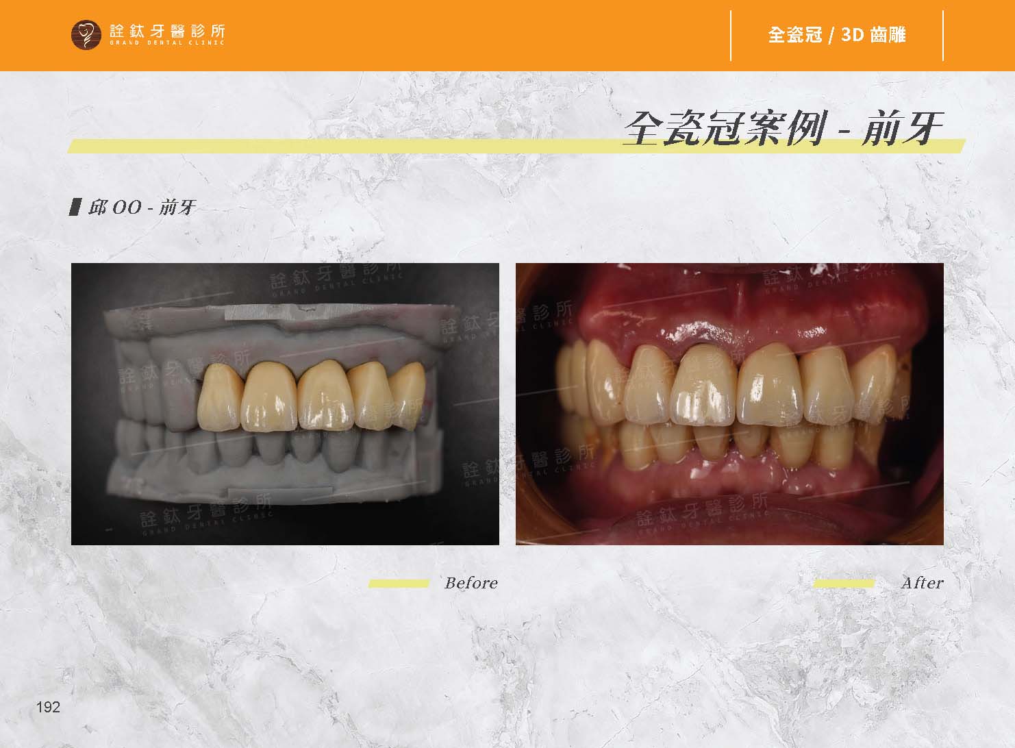 超仿真全瓷牙冠