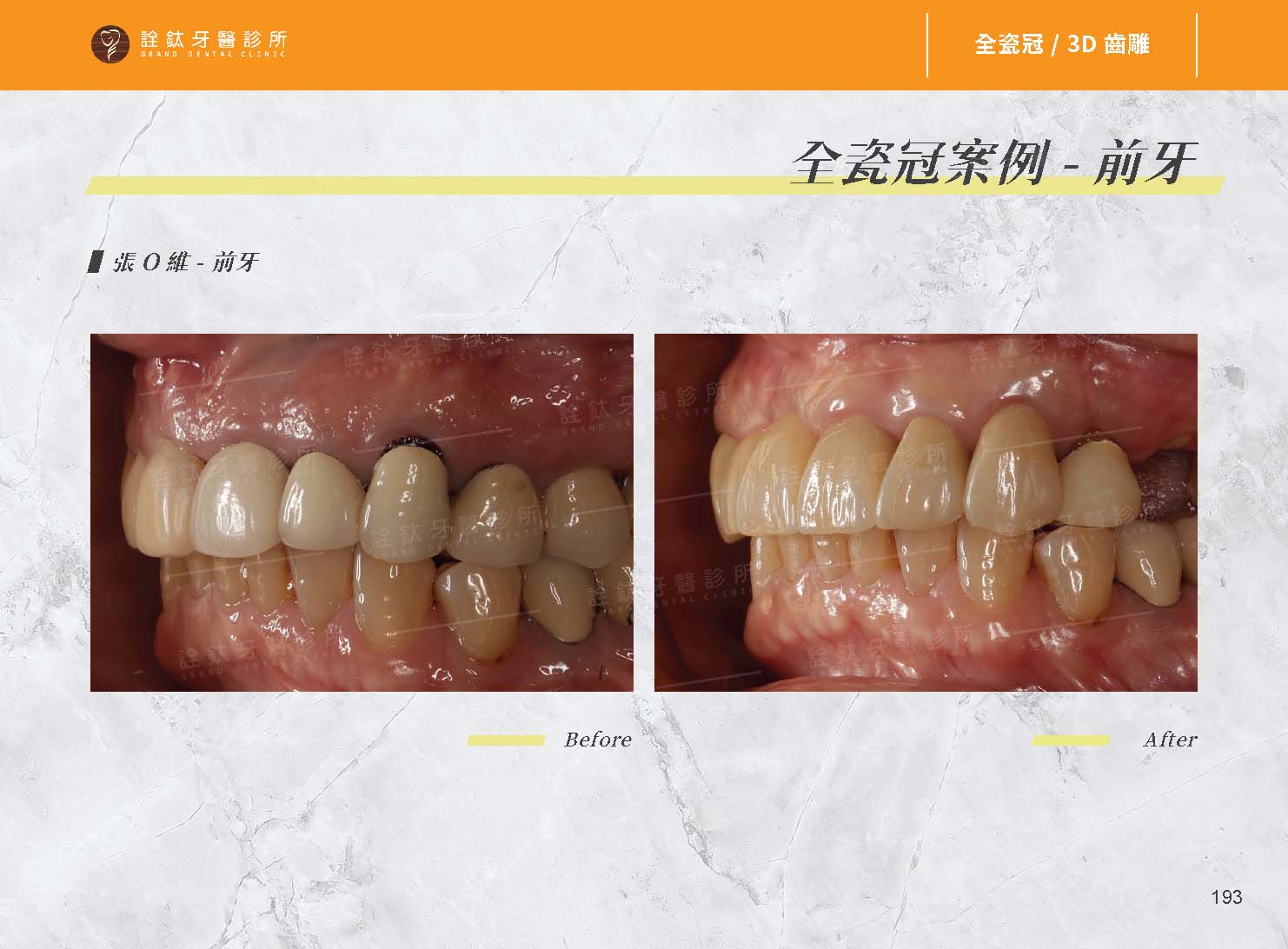 超仿真全瓷牙冠