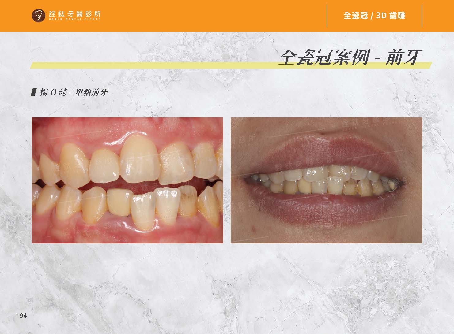 超仿真全瓷牙冠