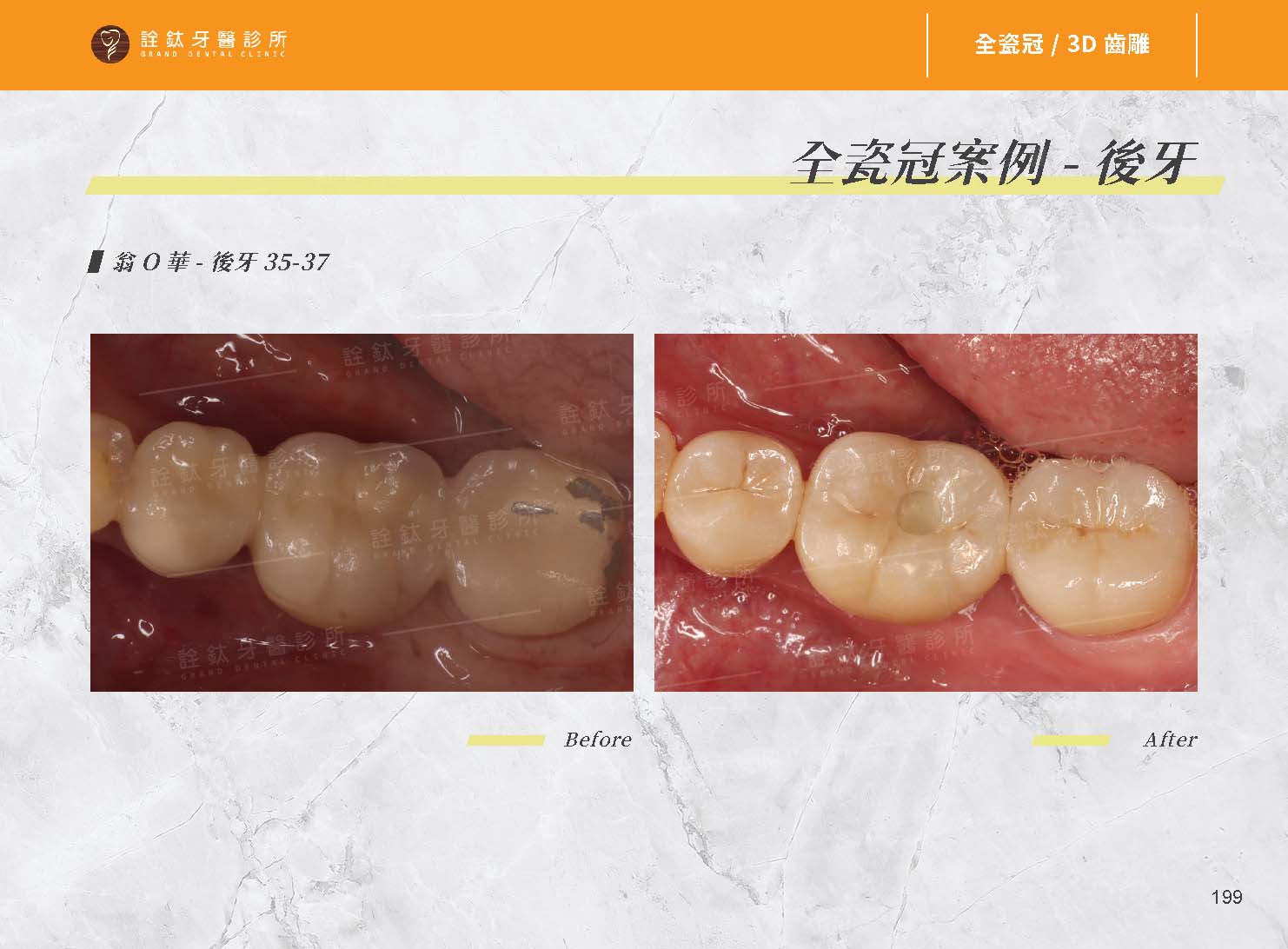 超仿真全瓷牙冠