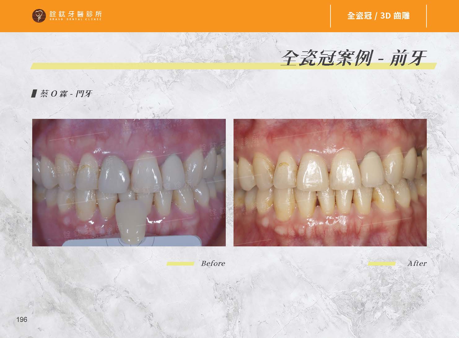 超仿真全瓷牙冠