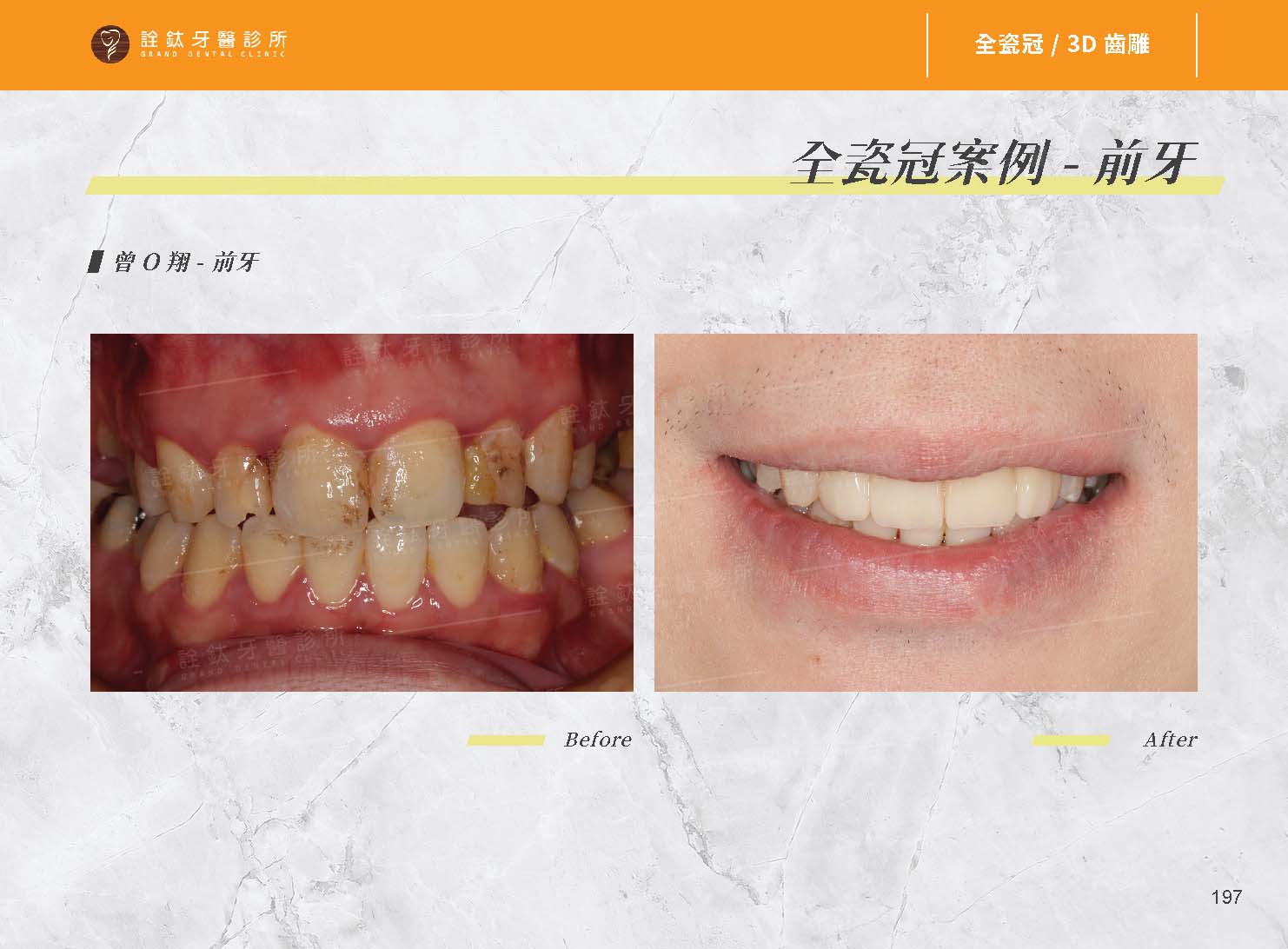 超仿真全瓷牙冠