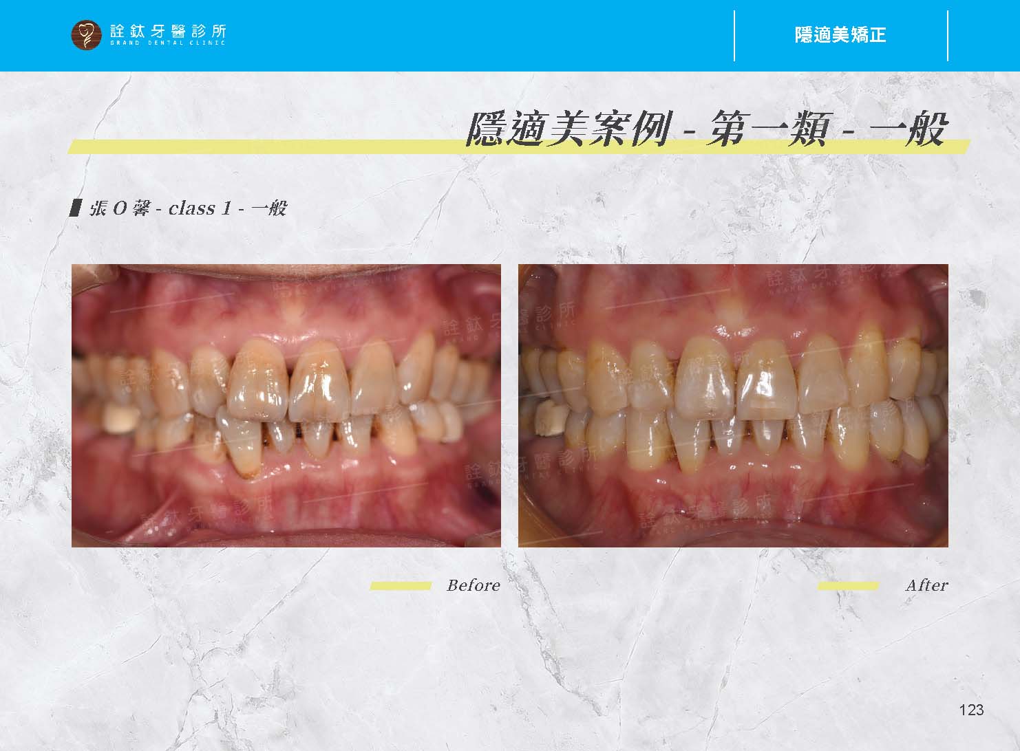 隱適美矯正 隱適美矯正
