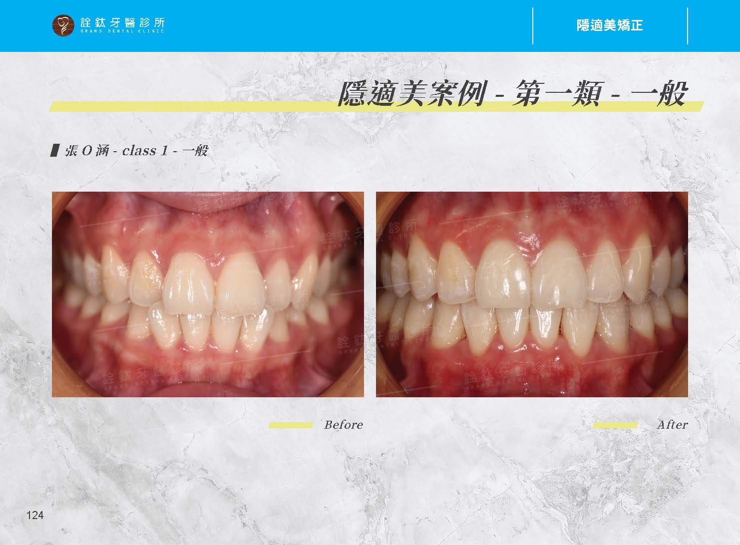 隱適美矯正 隱適美矯正