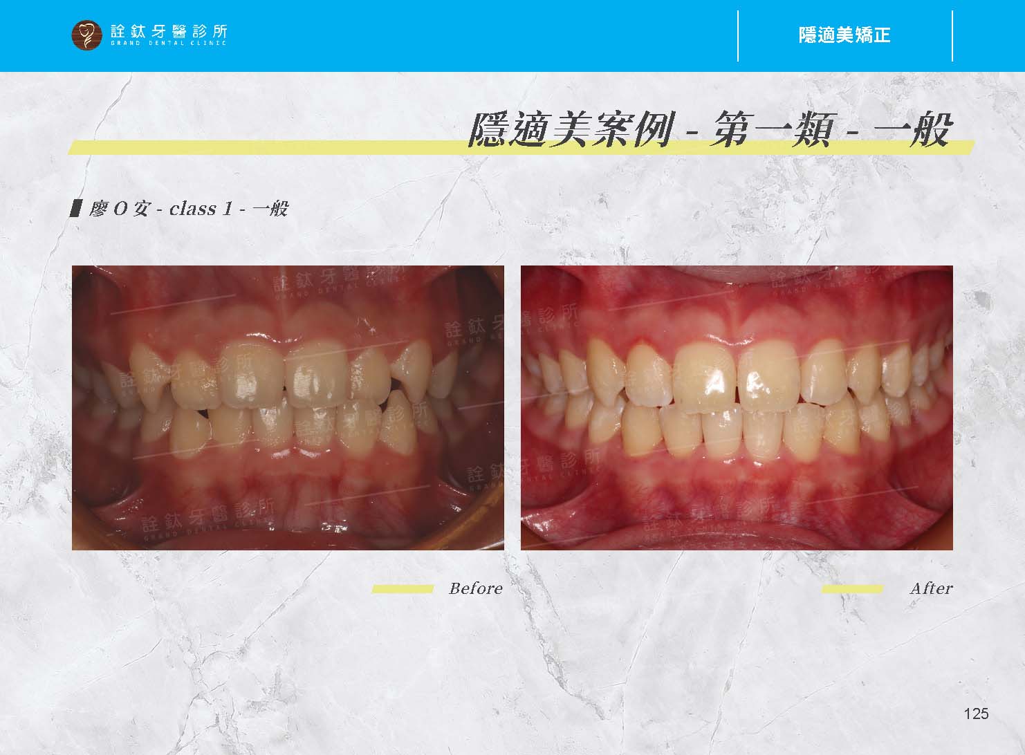 隱適美矯正 隱適美矯正