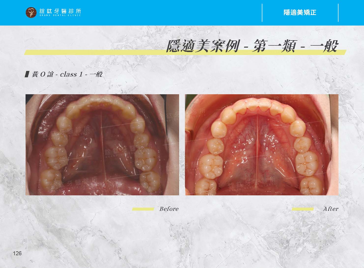 隱適美矯正 隱適美矯正