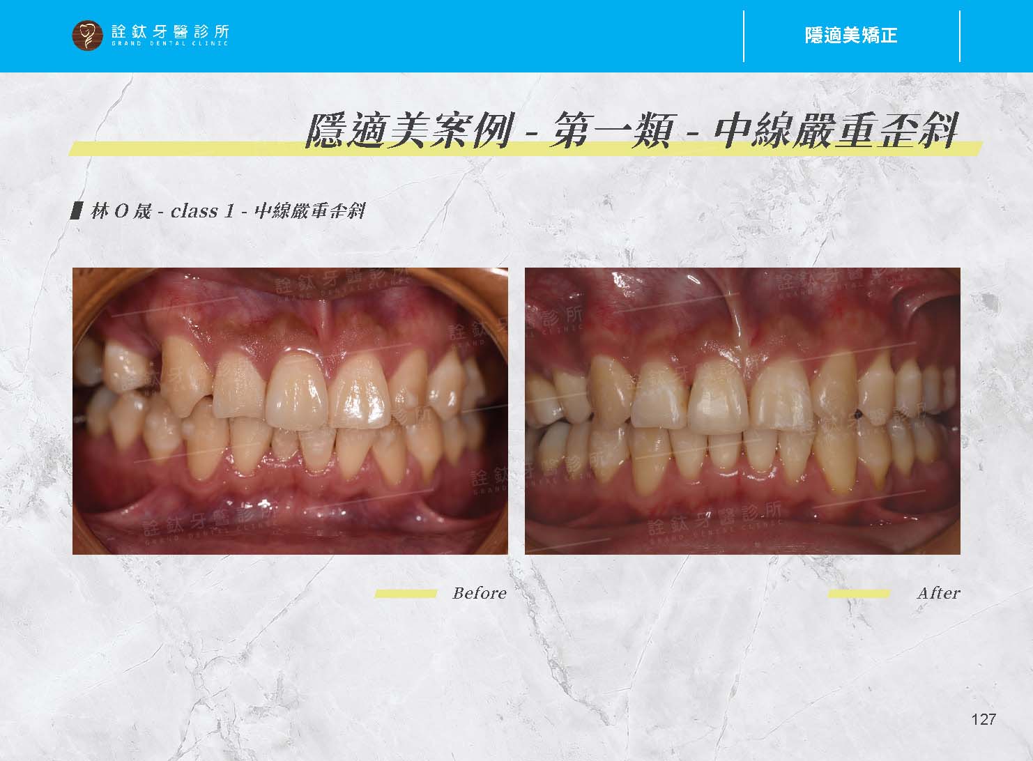 隱適美矯正 隱適美矯正