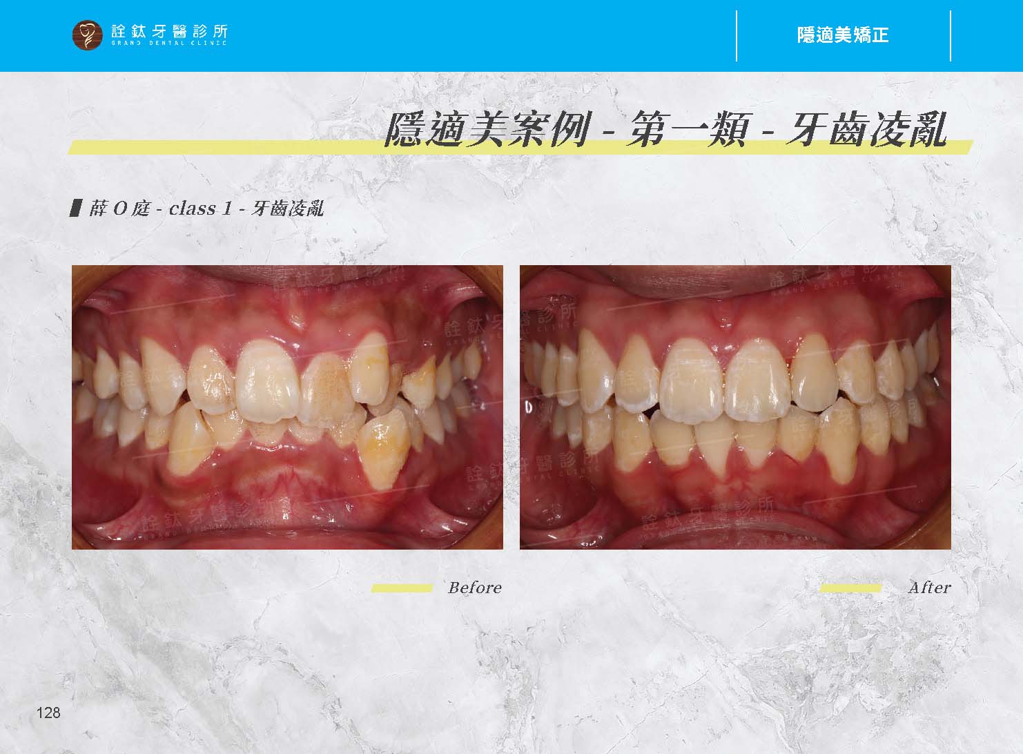 隱適美矯正 隱適美矯正