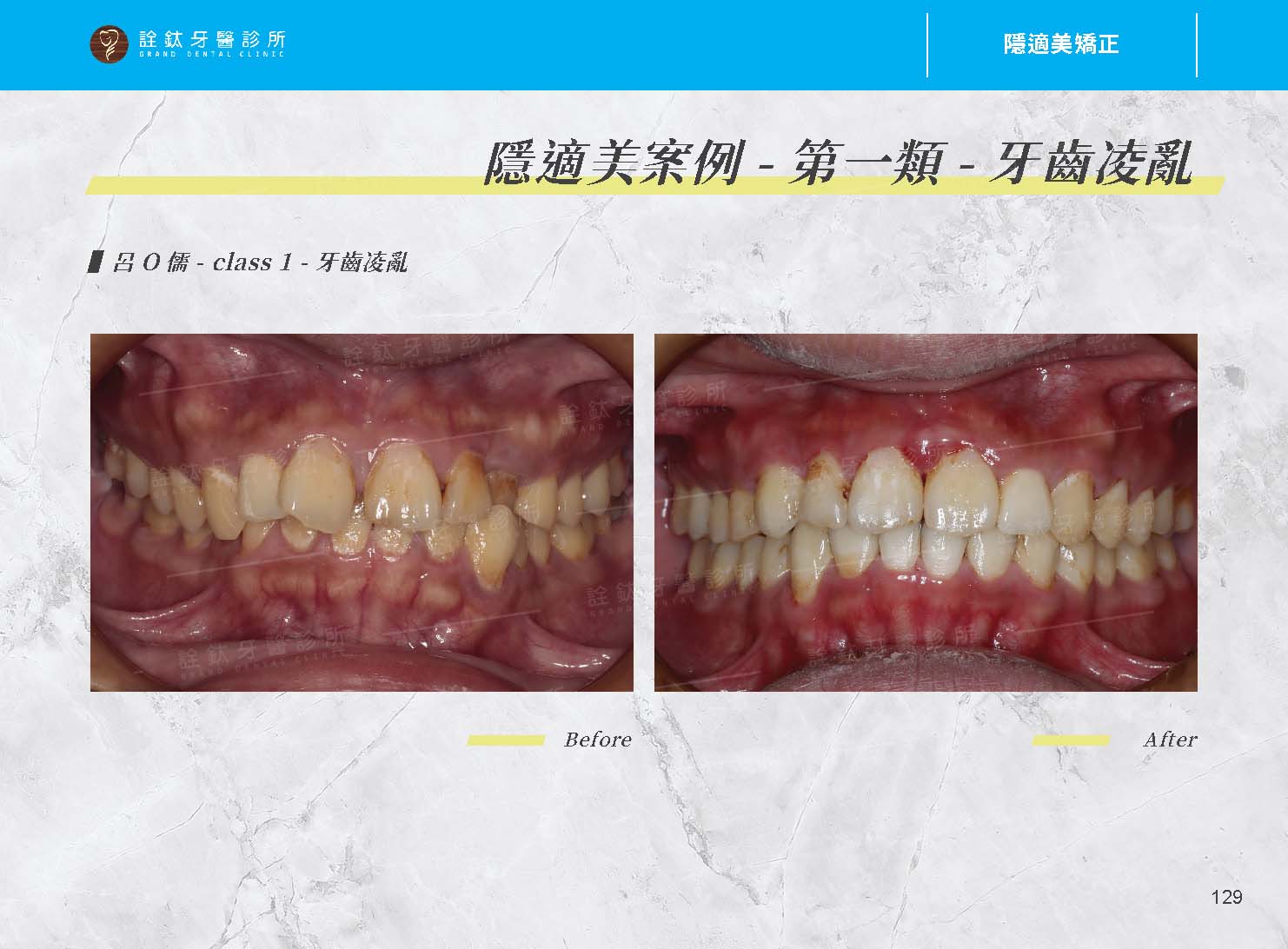 隱適美矯正 隱適美矯正
