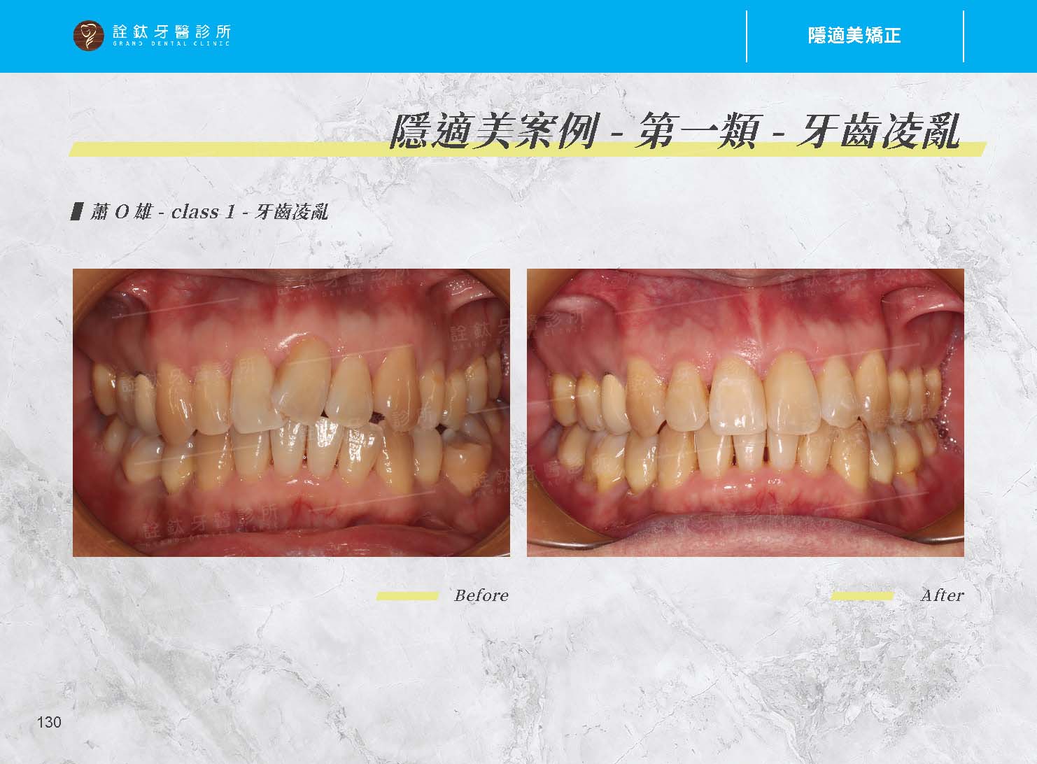 隱適美矯正 隱適美矯正