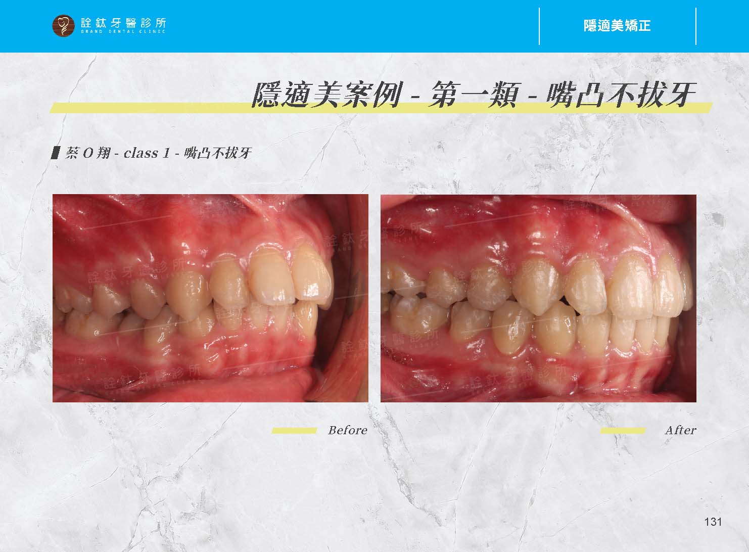 隱適美矯正 隱適美矯正