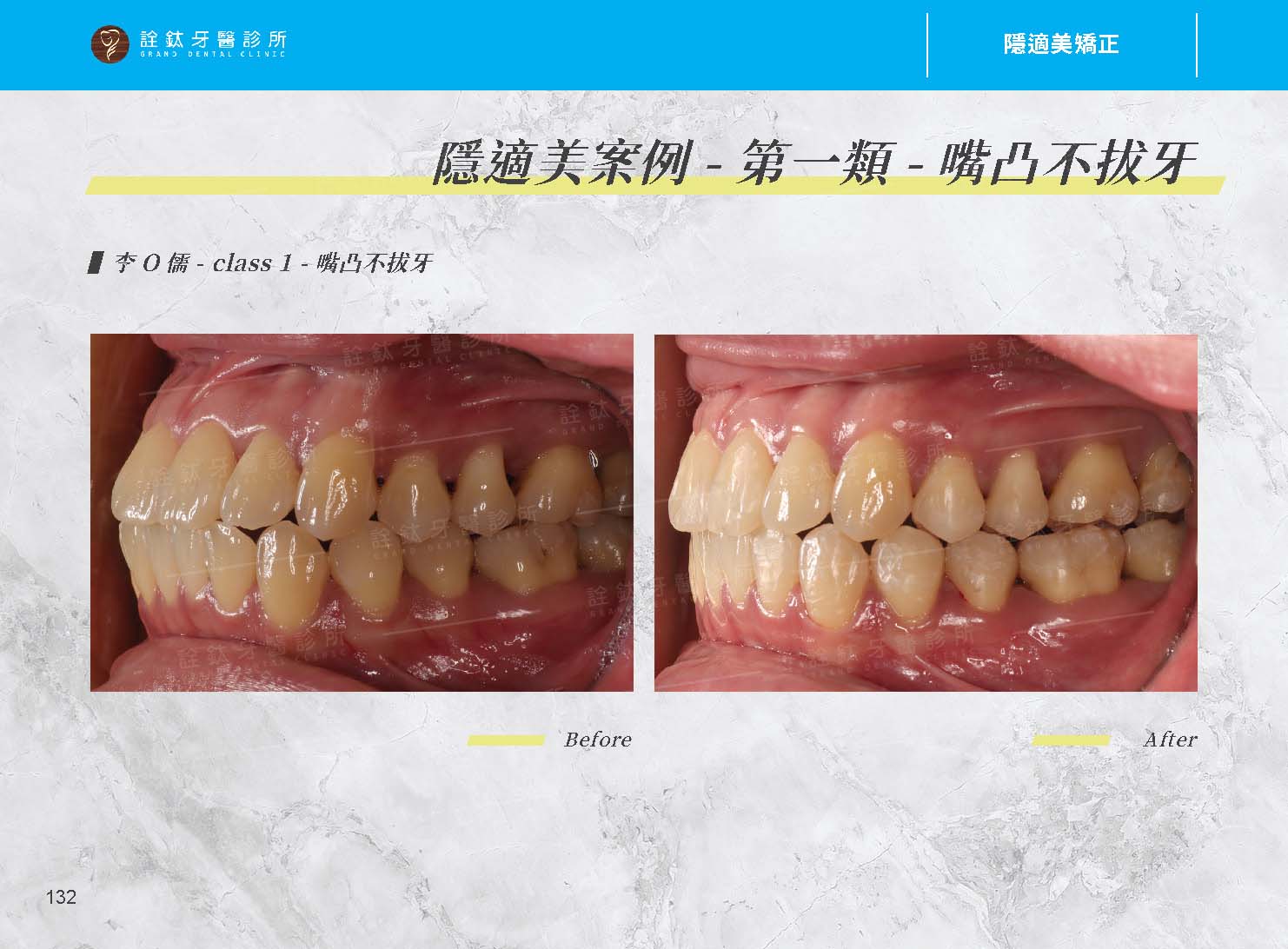 隱適美矯正 隱適美矯正