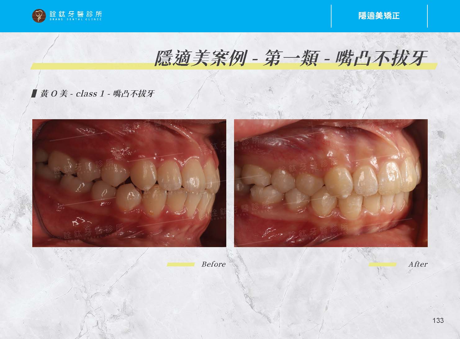 隱適美矯正 隱適美矯正