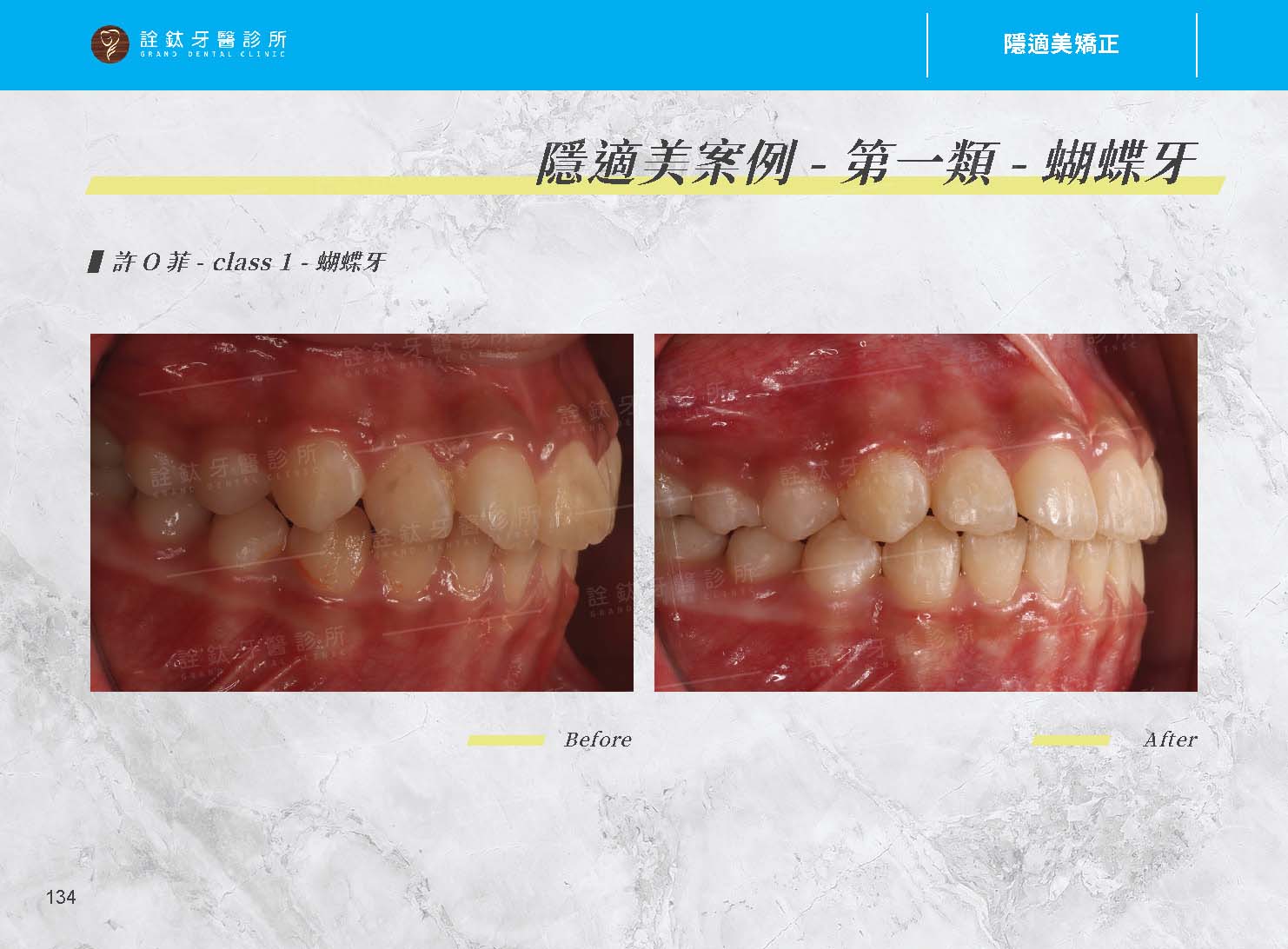隱適美矯正 隱適美矯正
