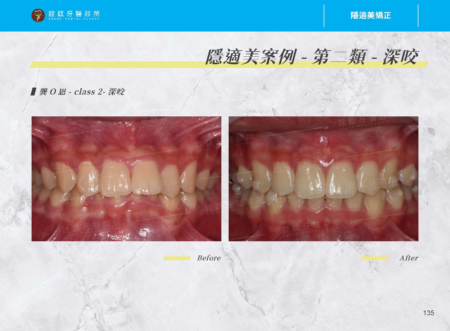 隱適美矯正 隱適美矯正