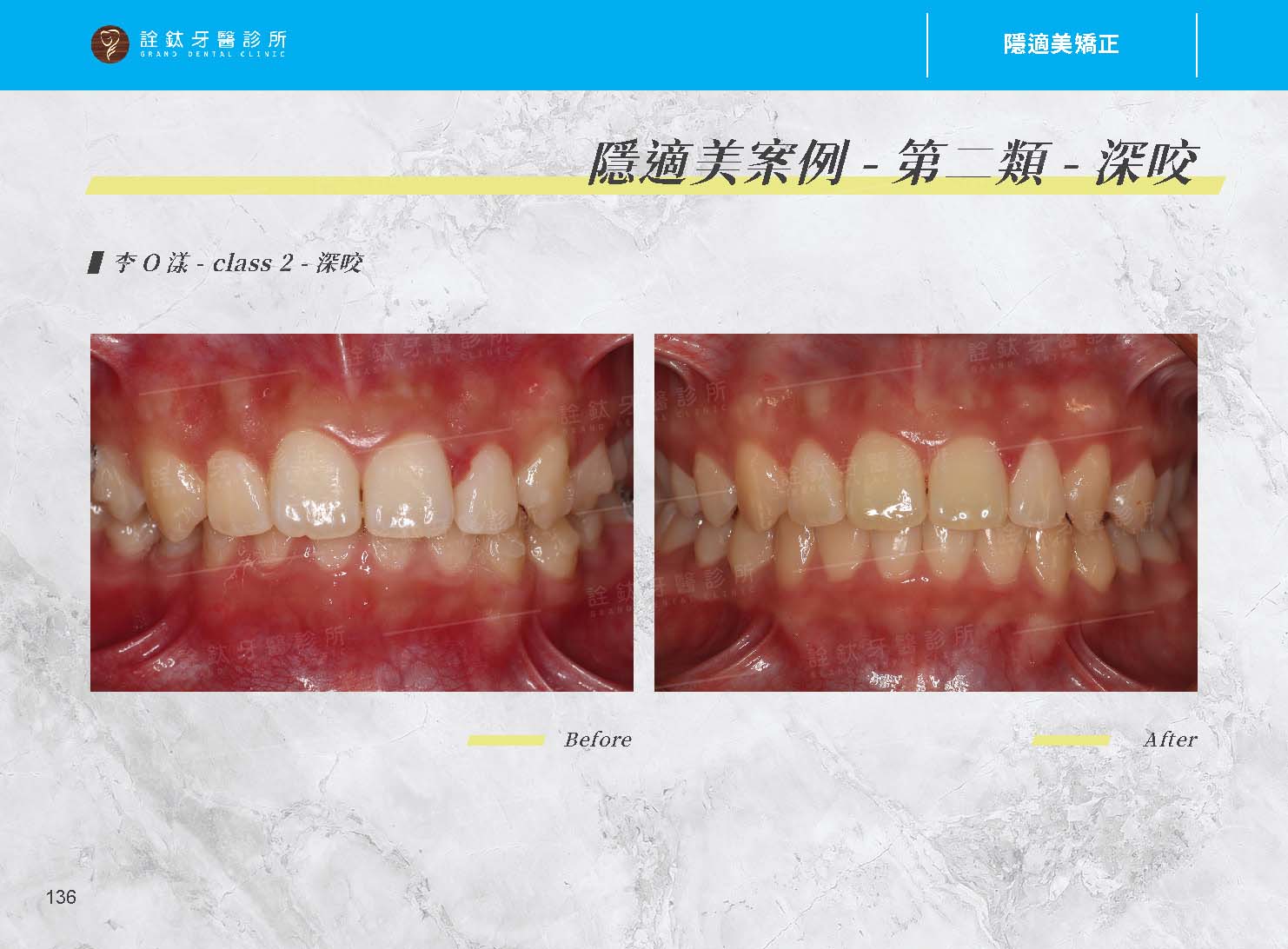 隱適美矯正 隱適美矯正
