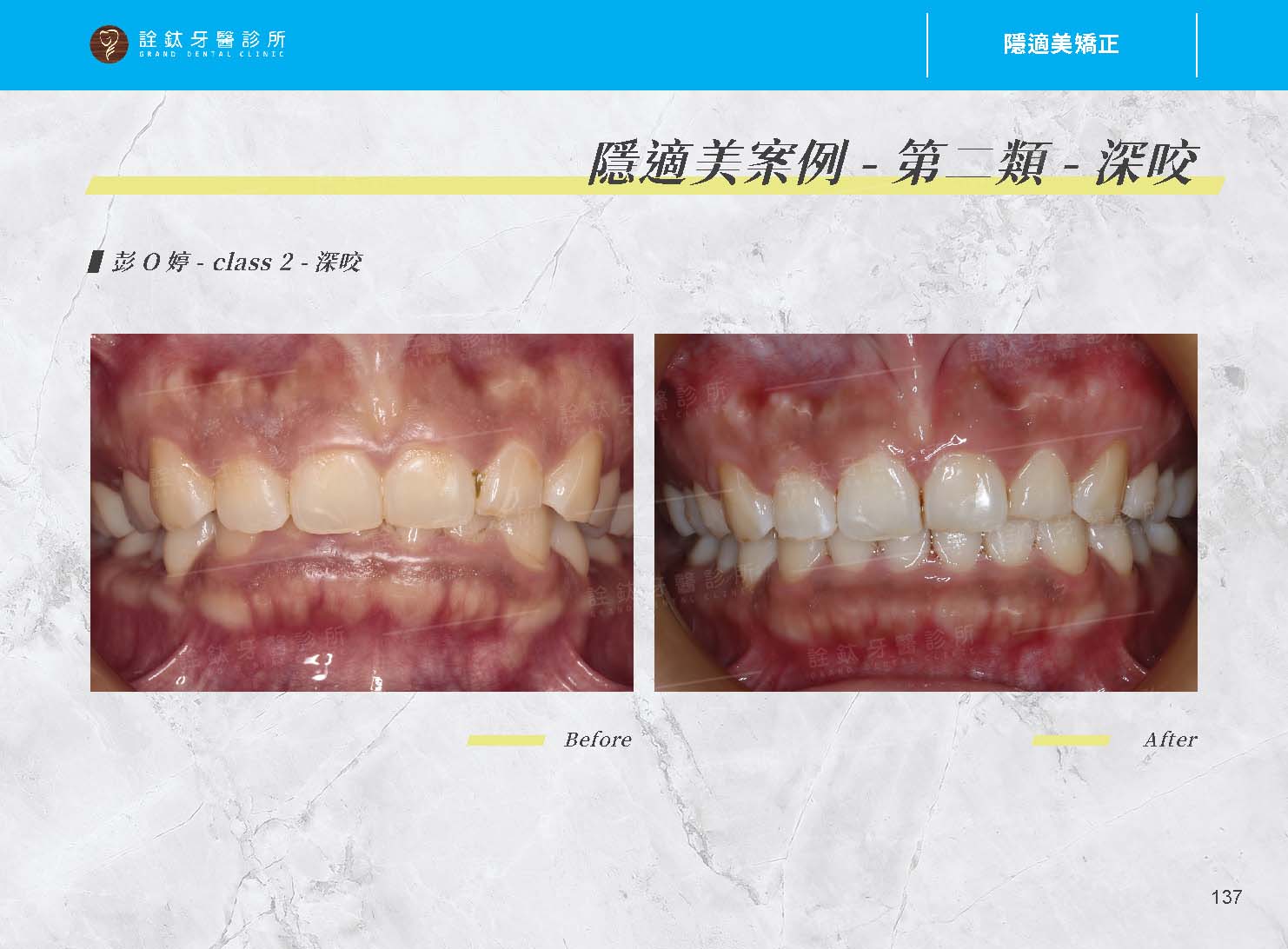 隱適美矯正 隱適美矯正