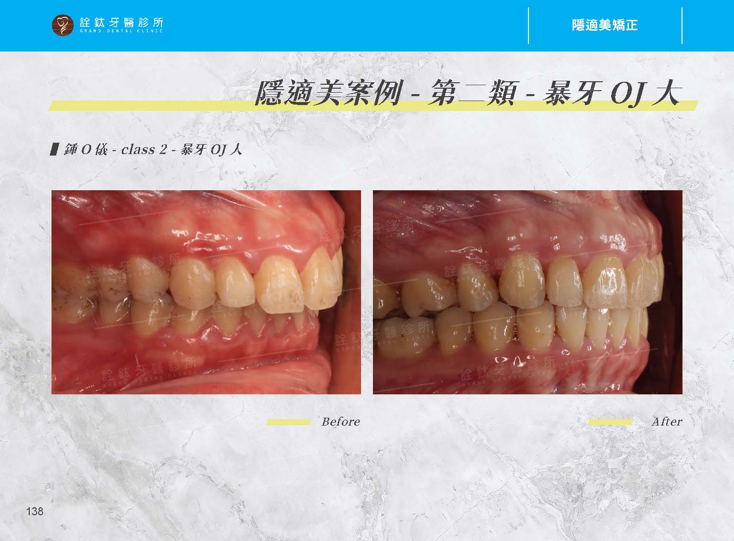 隱適美矯正 隱適美矯正