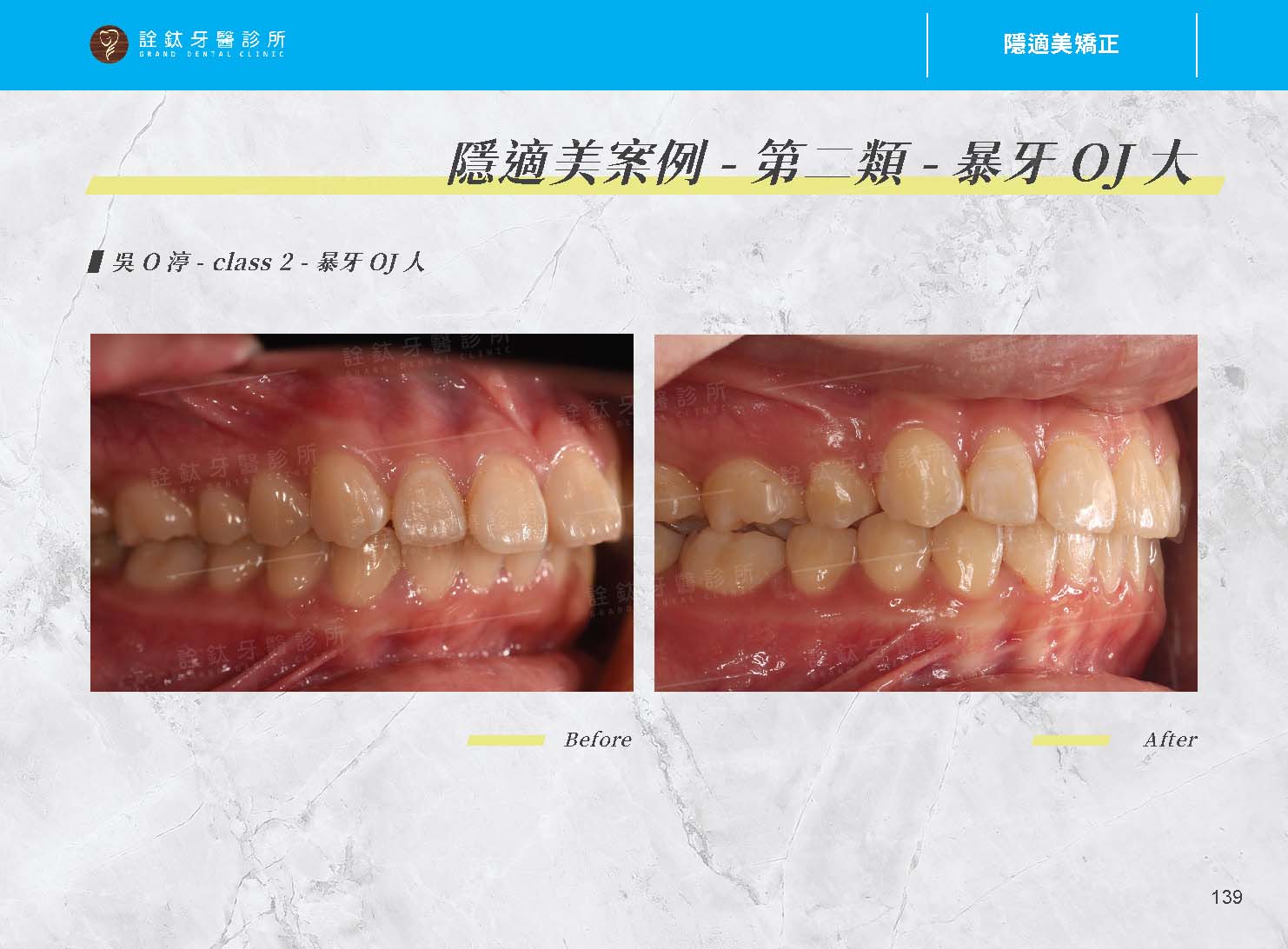 隱適美矯正 隱適美矯正