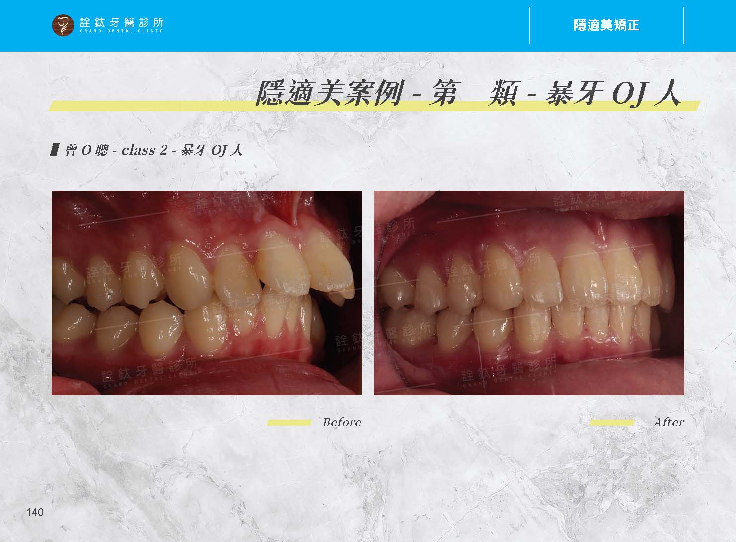 隱適美矯正 隱適美矯正
