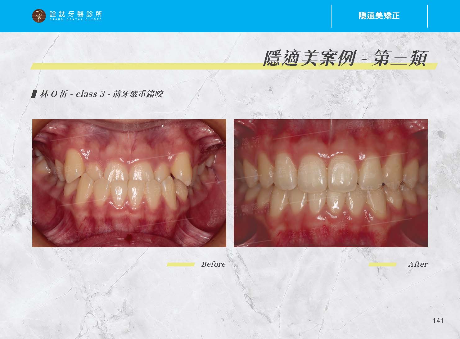 隱適美矯正 隱適美矯正