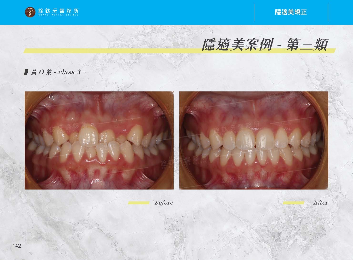 隱適美矯正 隱適美矯正