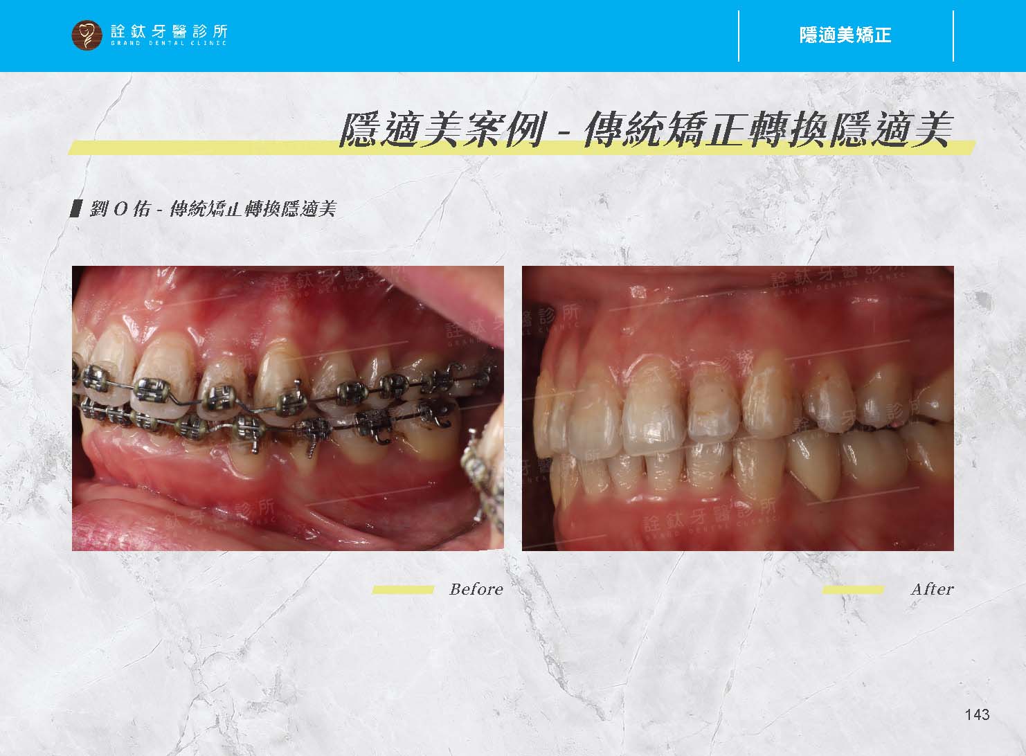 隱適美矯正 隱適美矯正