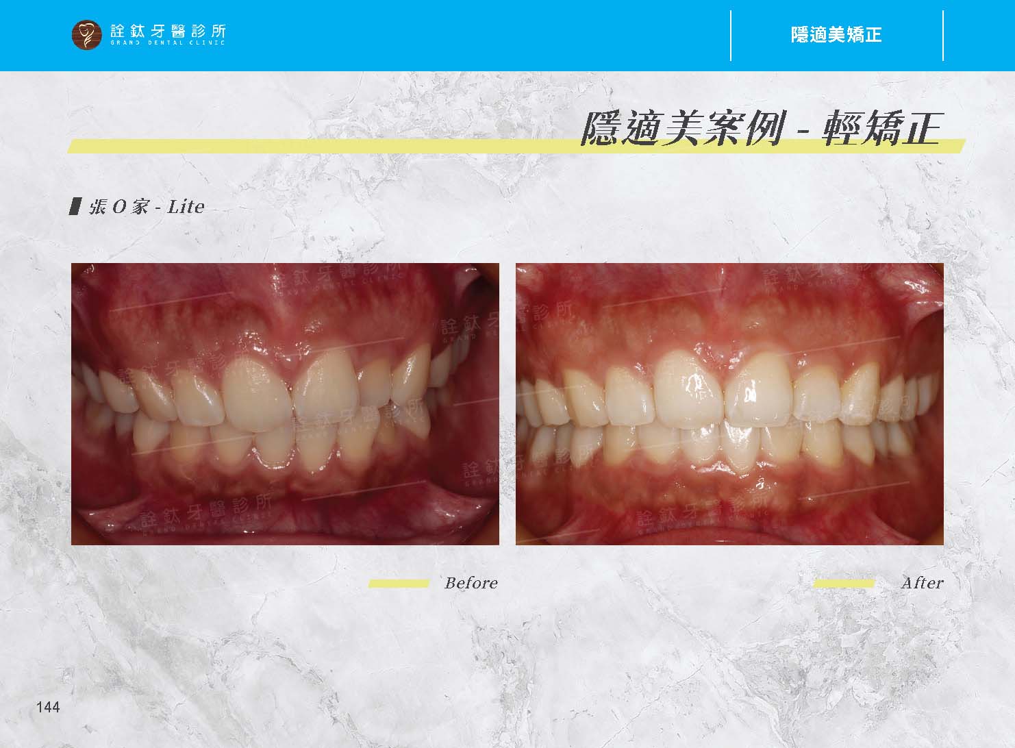隱適美矯正 隱適美矯正