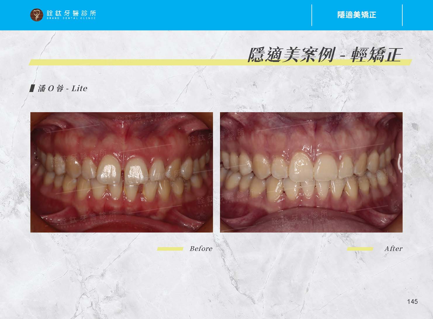 隱適美矯正 隱適美矯正