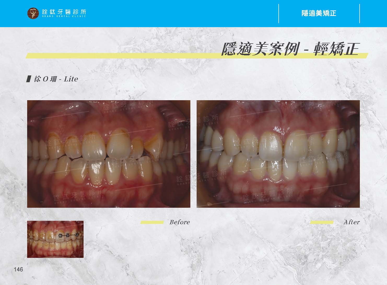 隱適美矯正 隱適美矯正